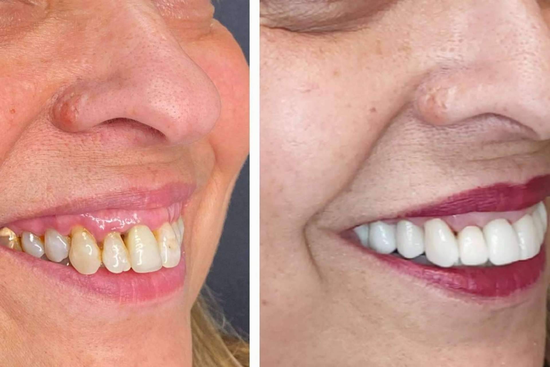 Todo lo que hay que saber sobre las carillas dentales, por la clínica Dentinova