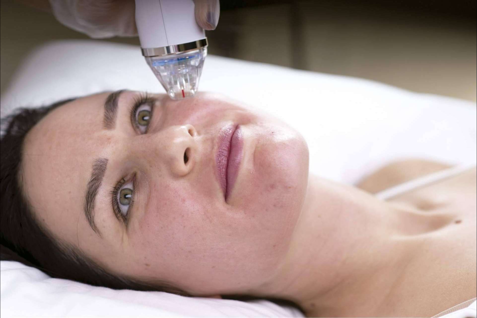 Alluring Clinic ofrece un tratamiento de radiofrecuencia fragmentada con microagujas