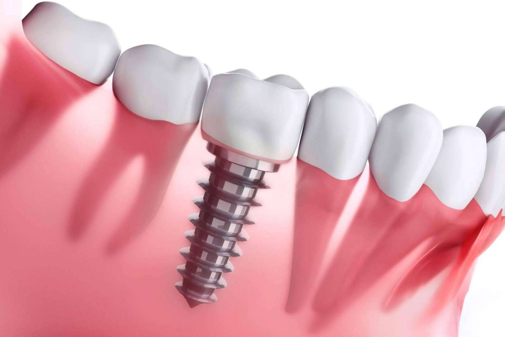 Clínica Dental Ahoa ofrece tratamientos de implantología dental de carga inmediata