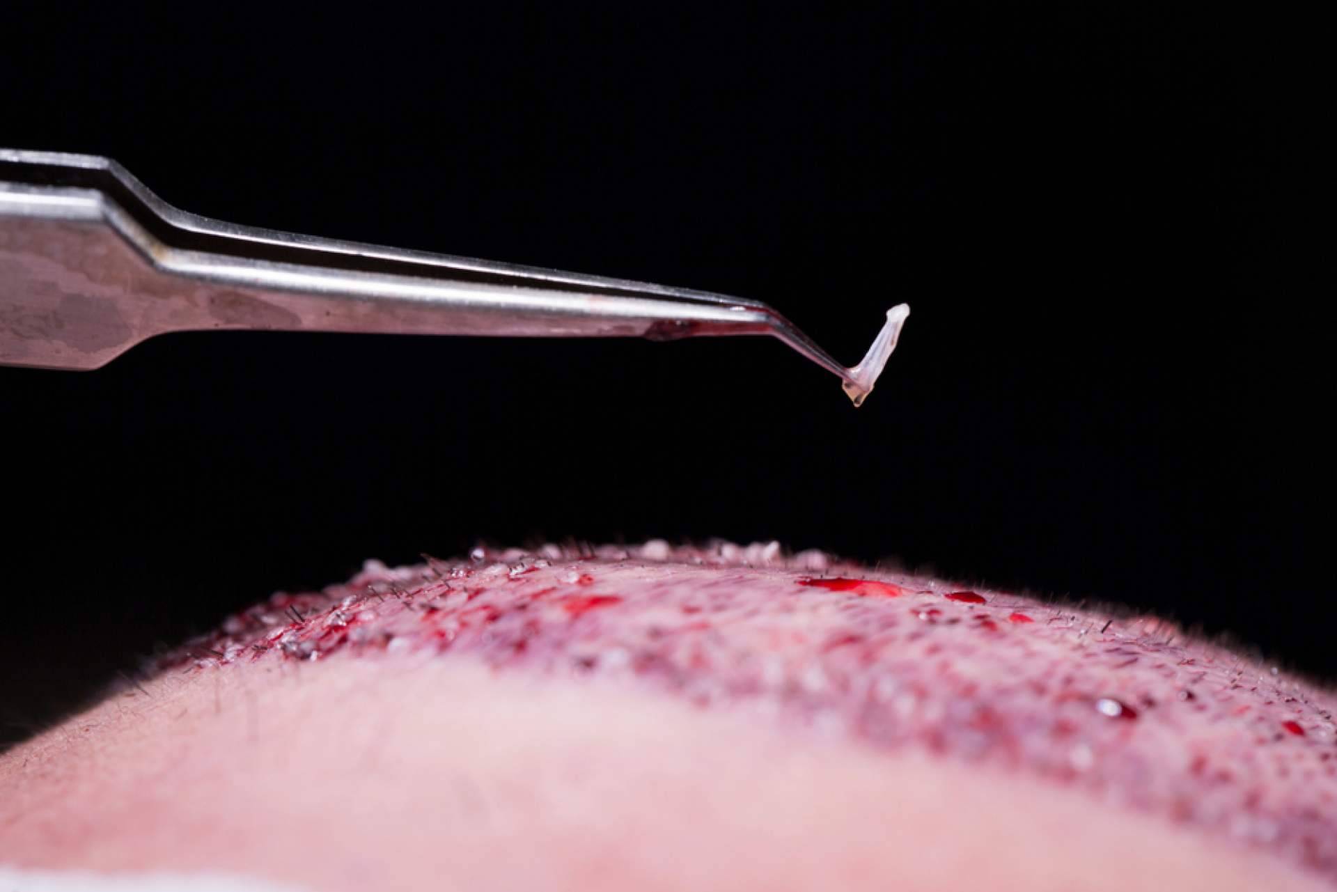 ¿Cuáles son los beneficios del plasma rico en plaquetas?, por Élite Capilar