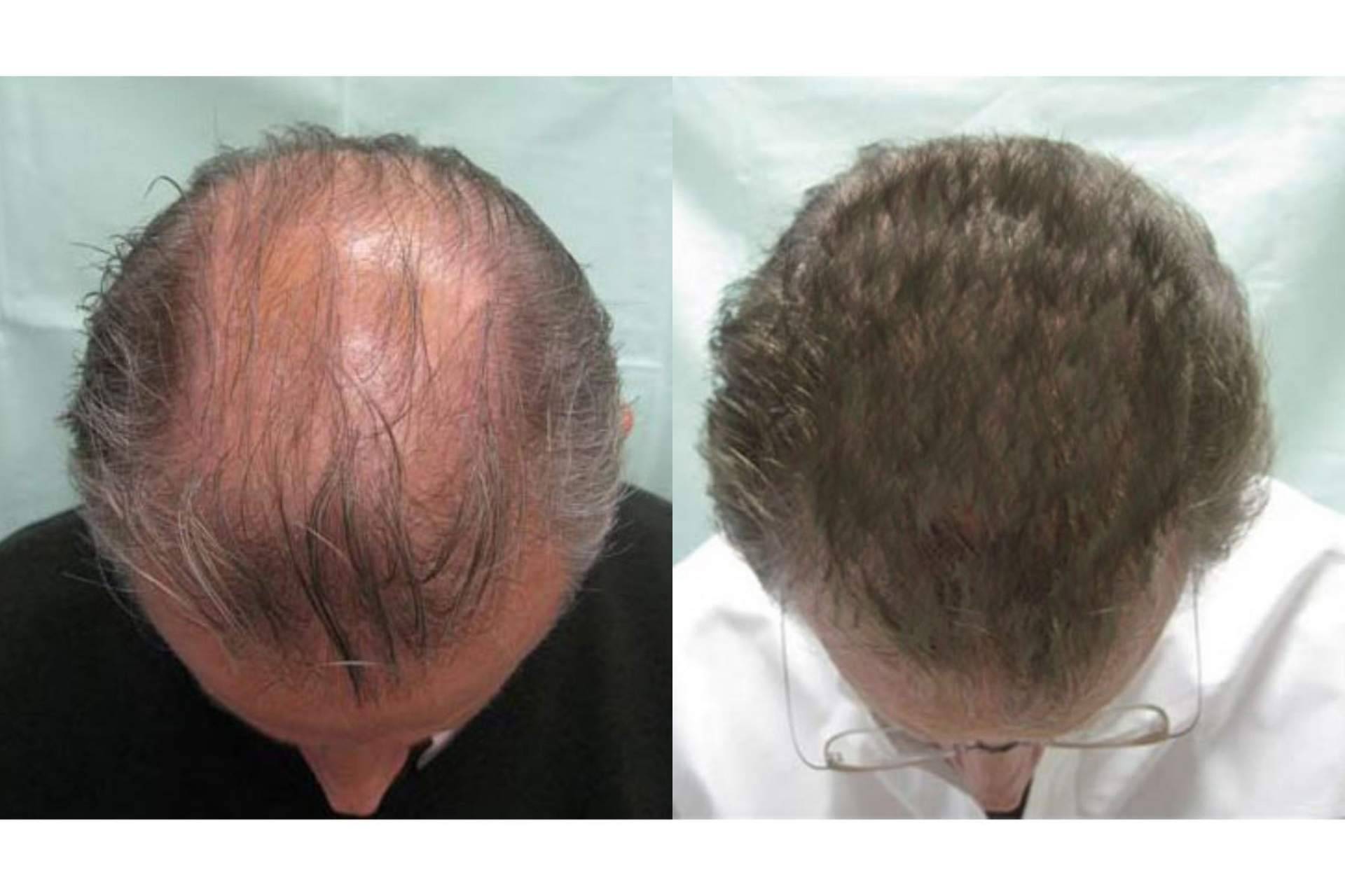 Tratamientos efectivos para alopecia androgenética en la clínica capilar Innovación Capilar