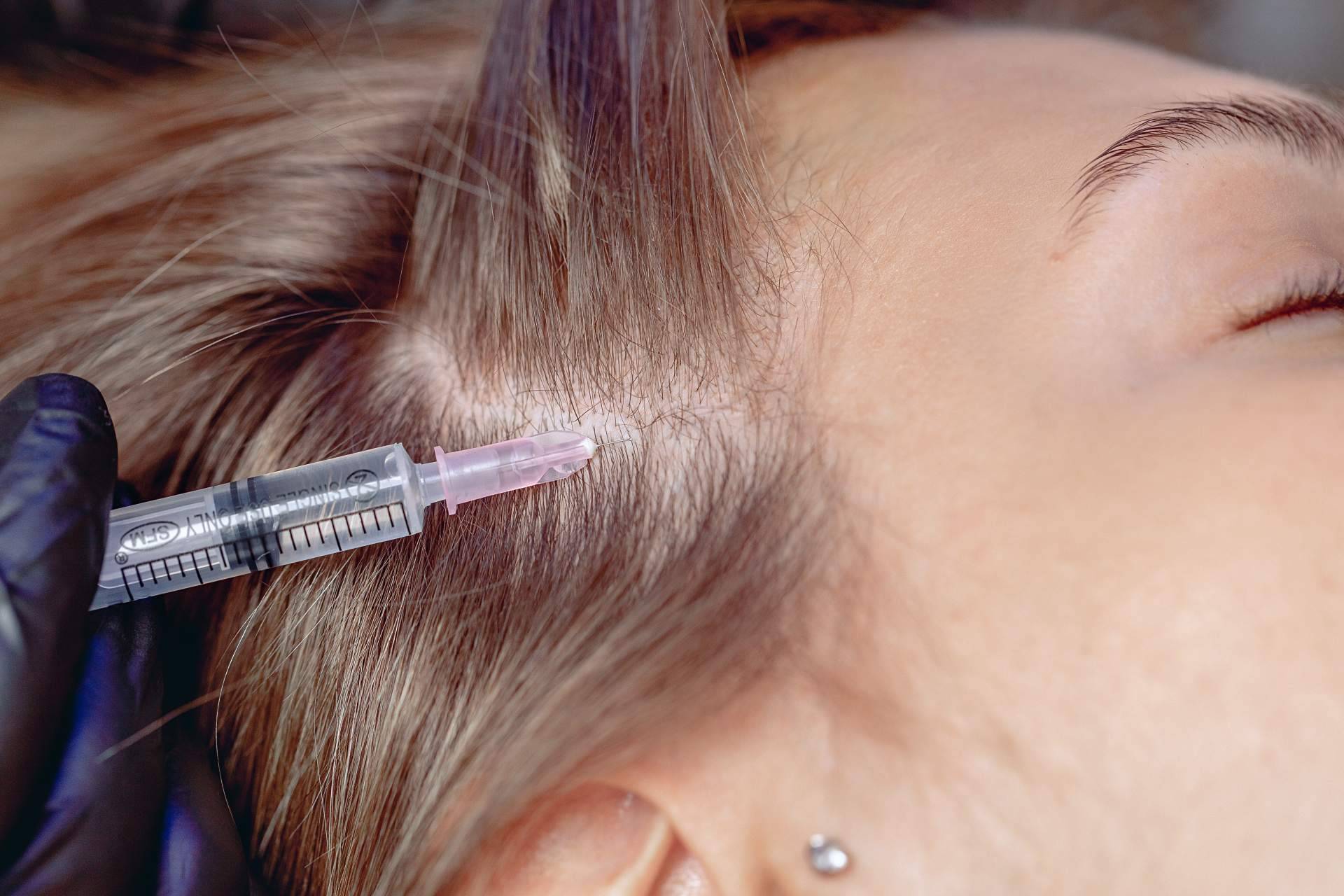 ¿En qué consiste la mesoterapia capilar, cuáles son sus efectos y su recuperación?, por Élite Capilar