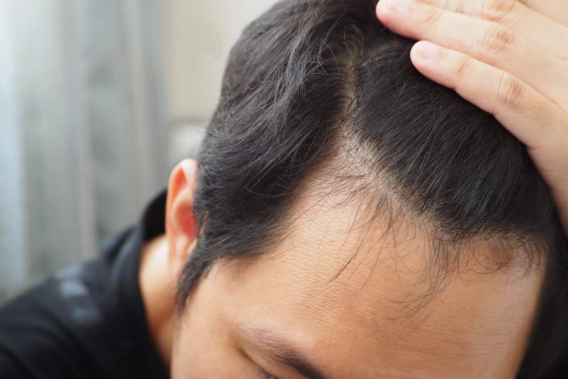 ¿En qué consiste el tratamiento de micropigmentación capilar?, por Élite Capilar