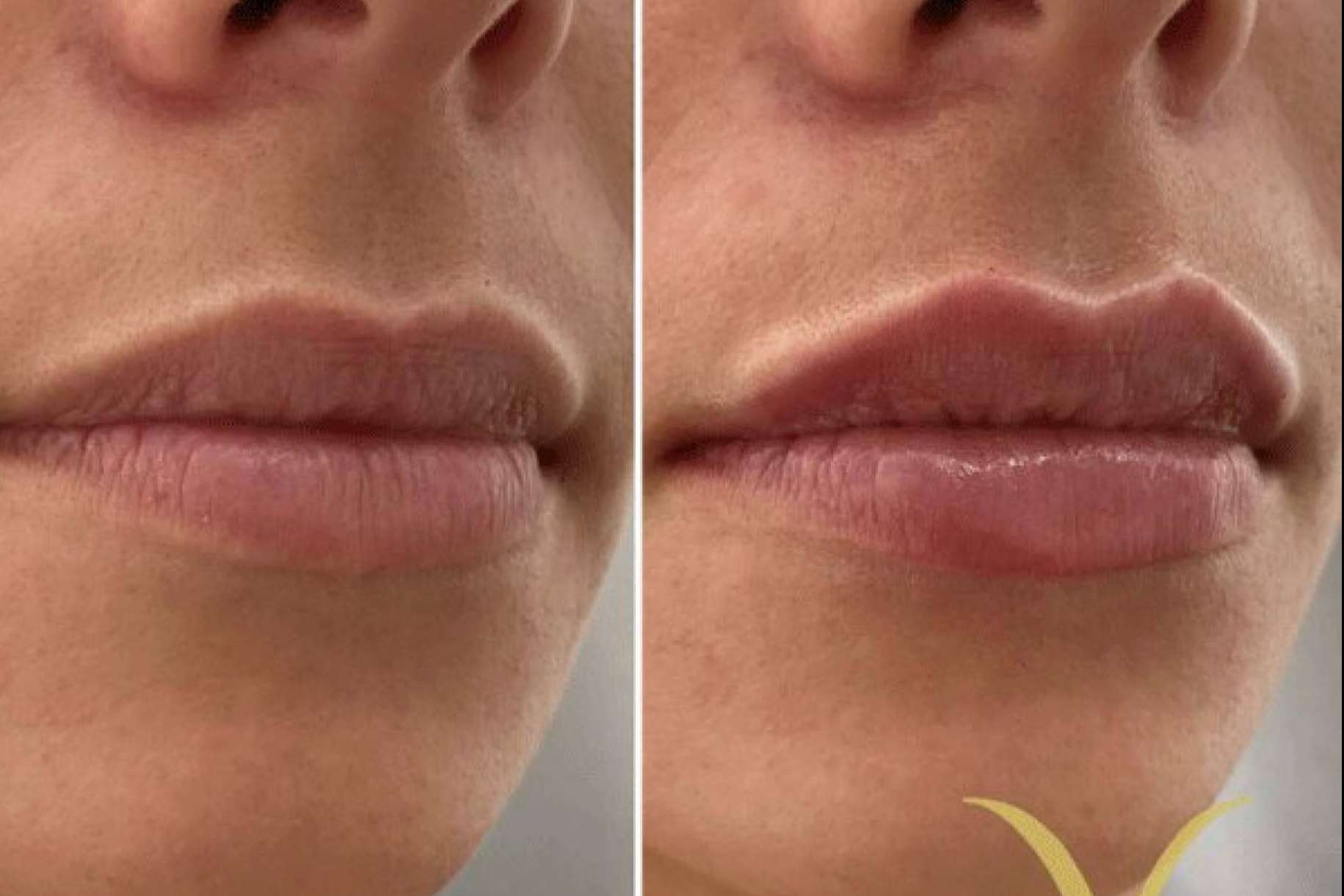 La técnica de la Clínica Yasmin para el aumento de labios con ácido hialurónico, Adiblips