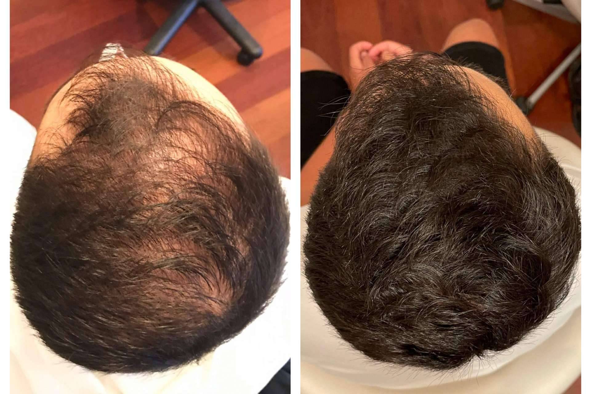 Infiltraciones dutasteride para tratar la alopecia, de la mano de la clínica dermatológica De Felipe