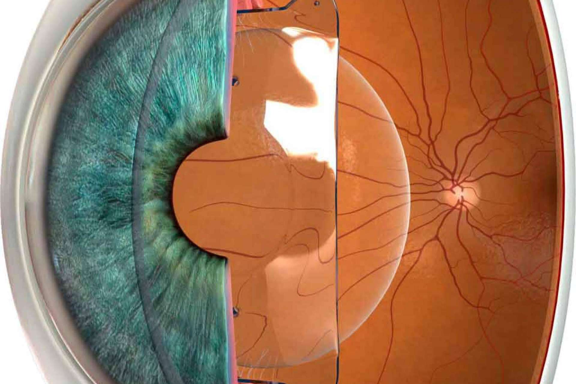¿Cómo se realiza la cirugía refractiva?