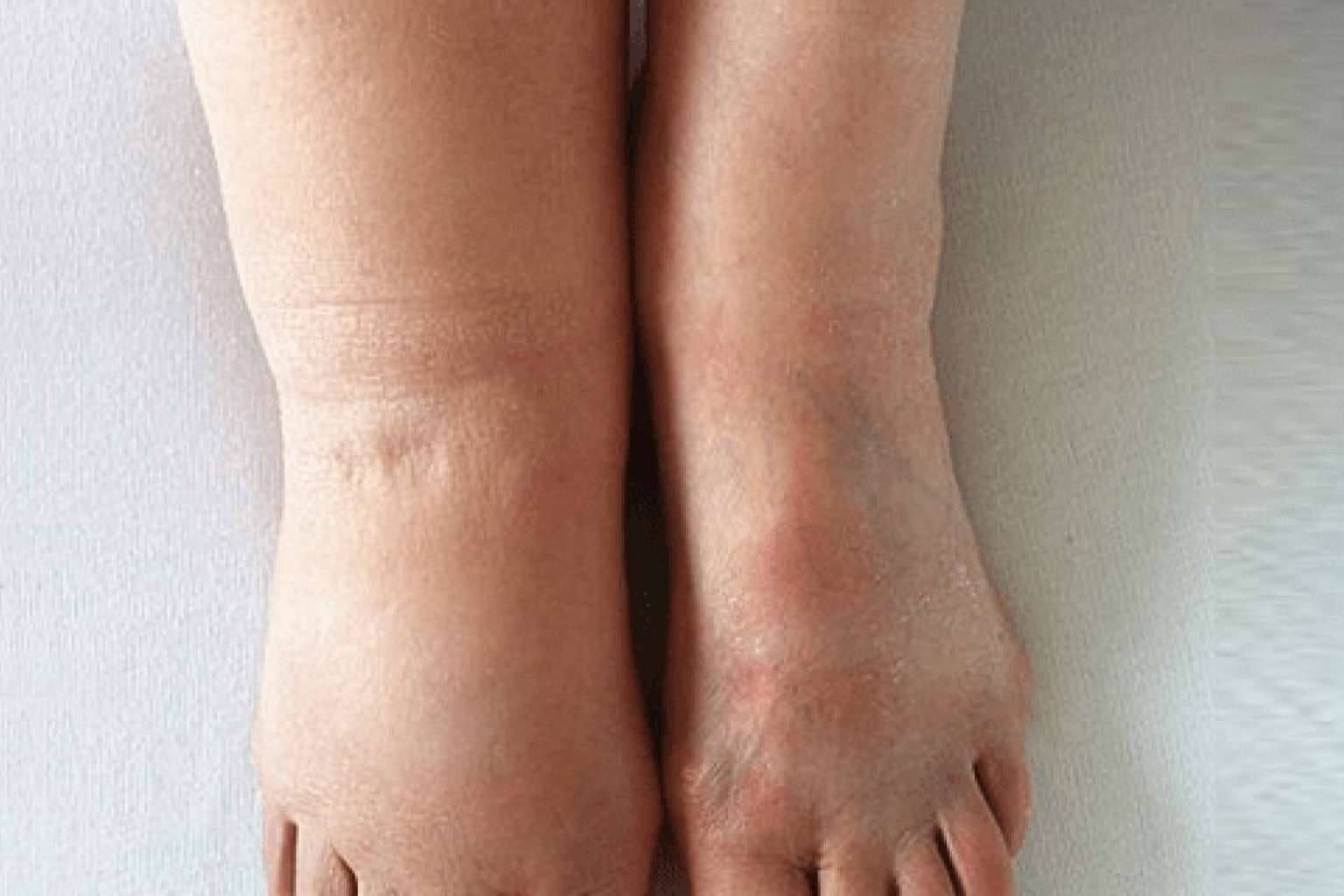 Una tecnología española reduce el linfedema en un 42 % en un mes