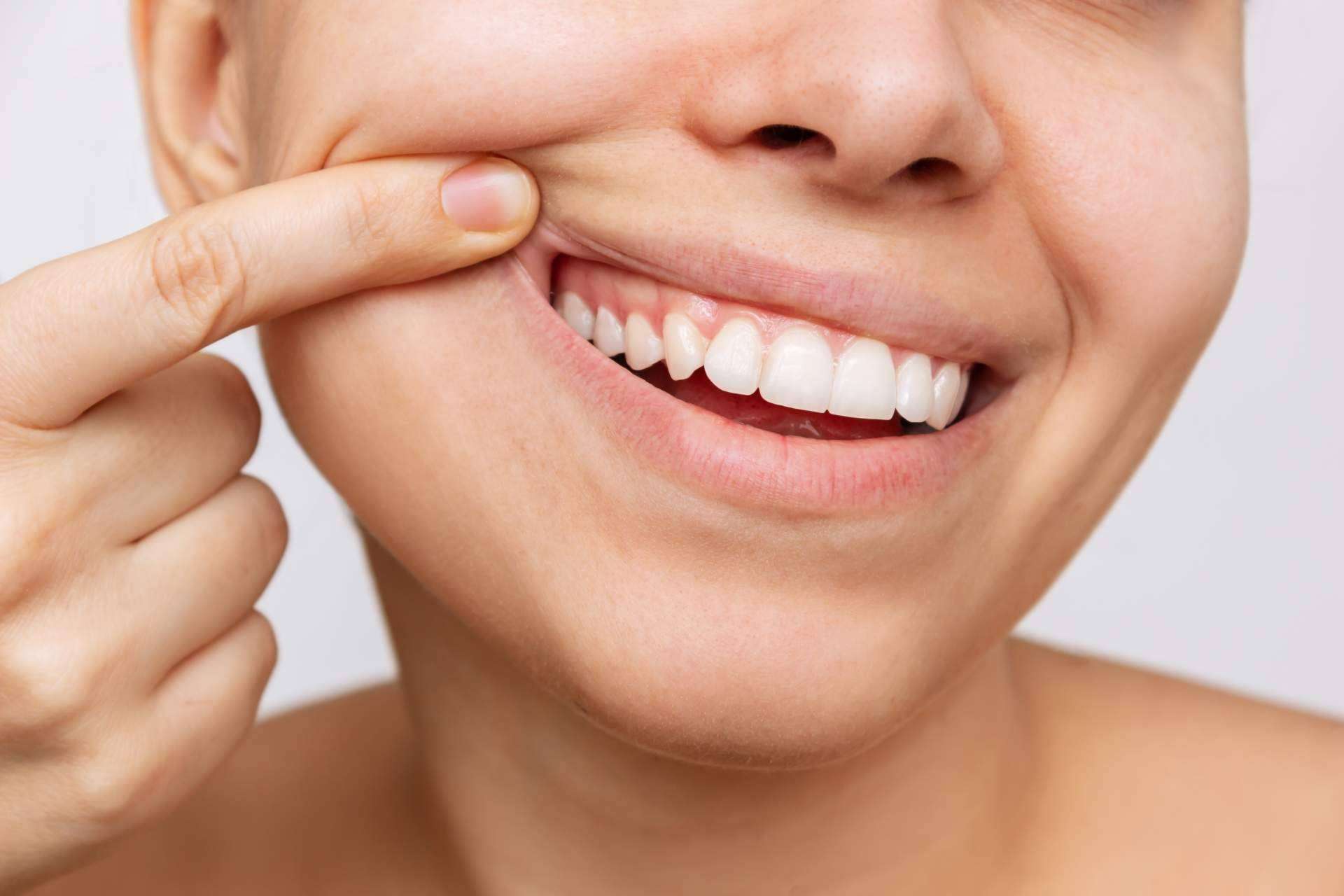 Clínicas Dental Bell, mejorar el aspecto de una sonrisa con un blanqueamiento dental