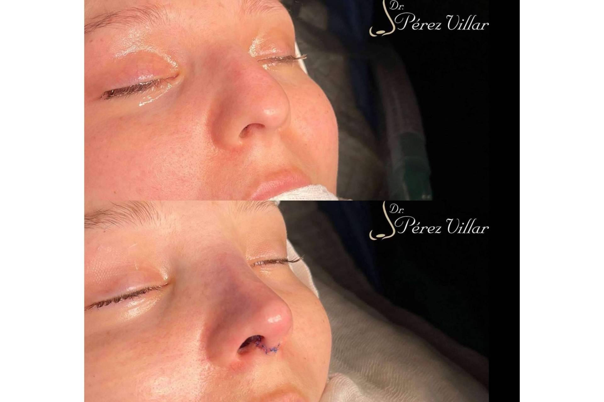 ¿Por qué la rinoplastia ultrasónica de preservación es una técnica cada vez más presente en el mundo de la estética?, por el Dr. Álvaro Pérez-Villar Bonet