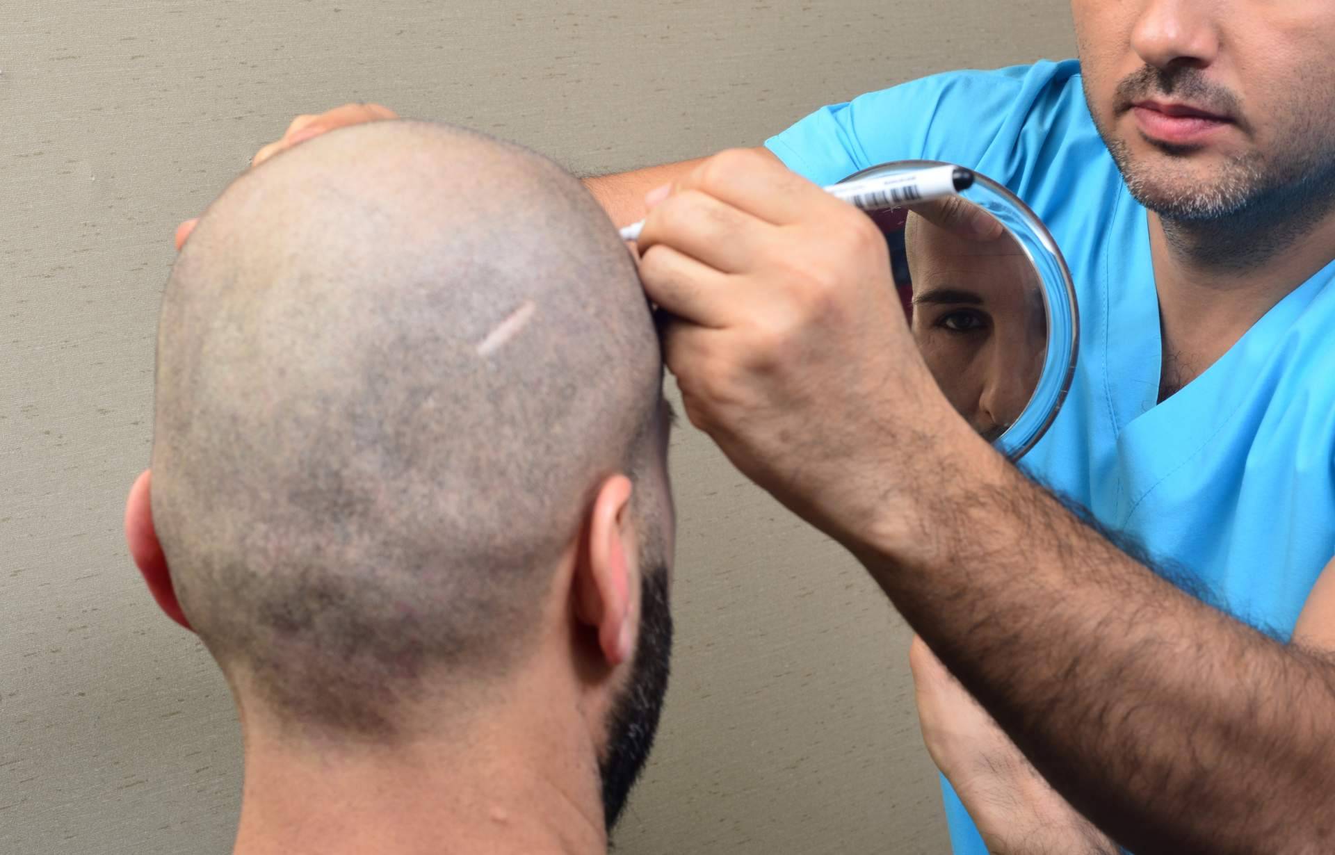 Clínicas Élite Capilar, expertos en el implante de pelo