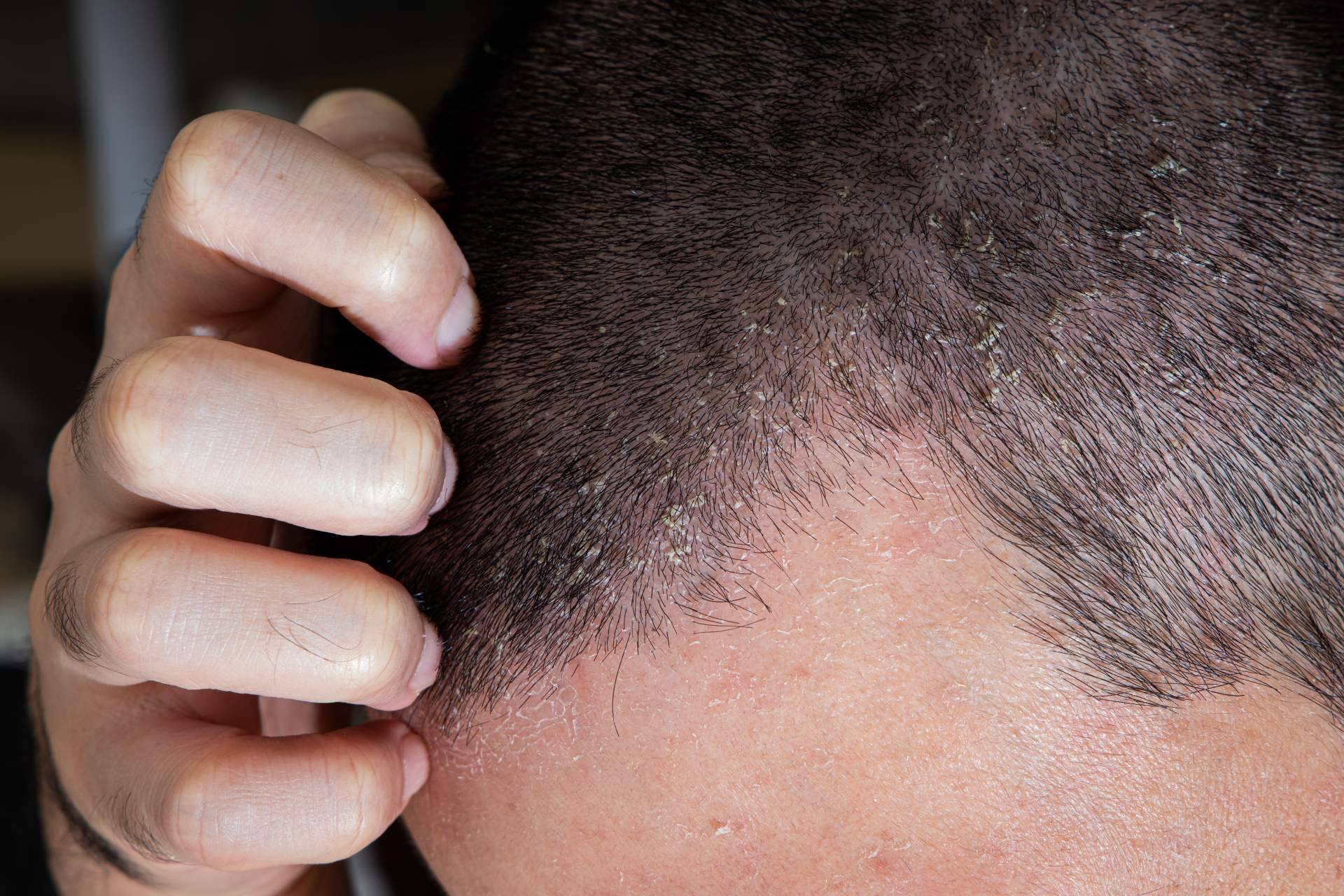 Dermatitis seborreica es una afección que puede generar alopecia si no se trata