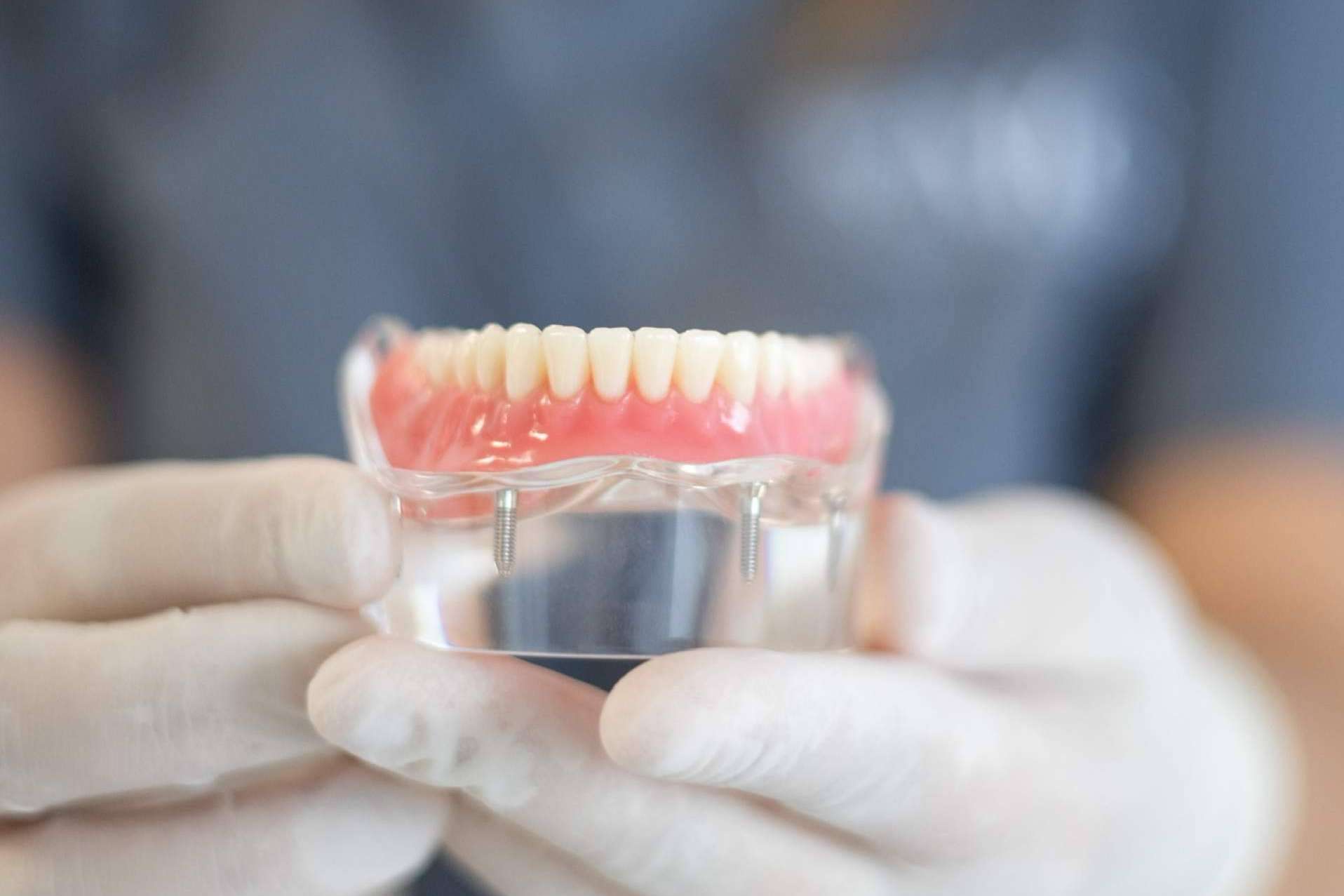 La Clínica MG Dental & Estética Facial y su servicio de implantes dentales de calidad