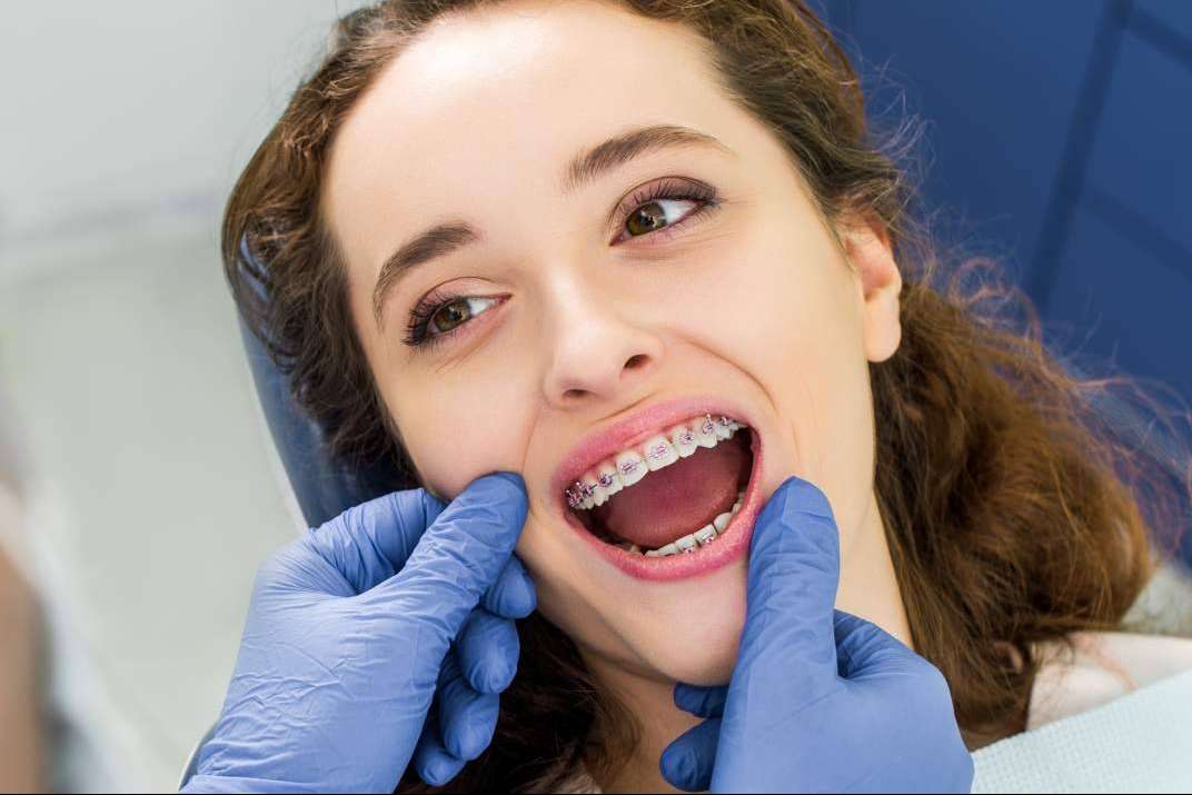 ¿Cuáles son los beneficios de la ortodoncia estética?, por Agudo Rosa