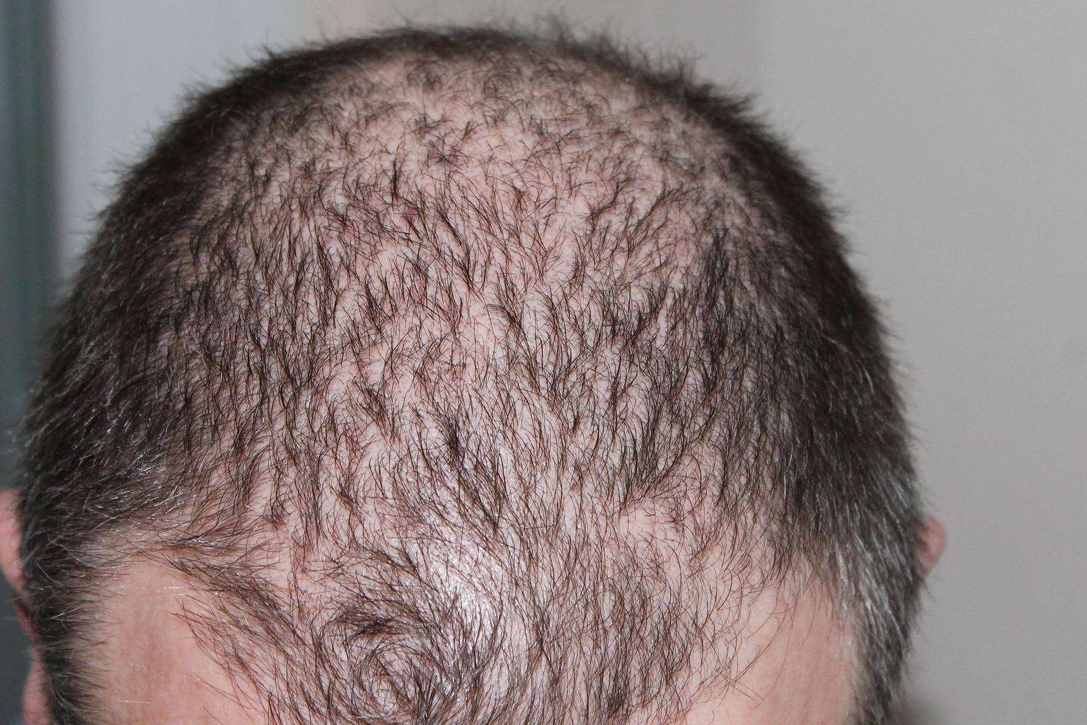 Contra la alopecia androgenética, la mesoterapia capilar con antiandrógenos se establece como un arma eficaz
