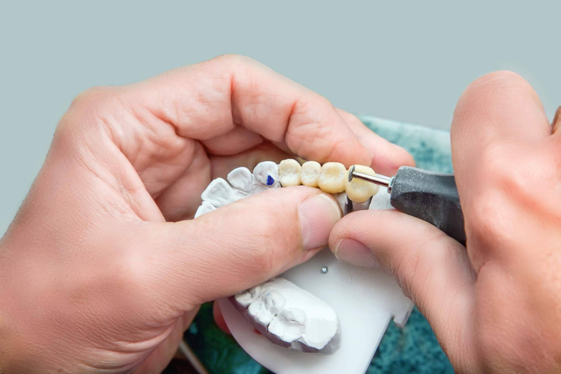¿Qué son las prótesis sobre implantes?, con DrMouth