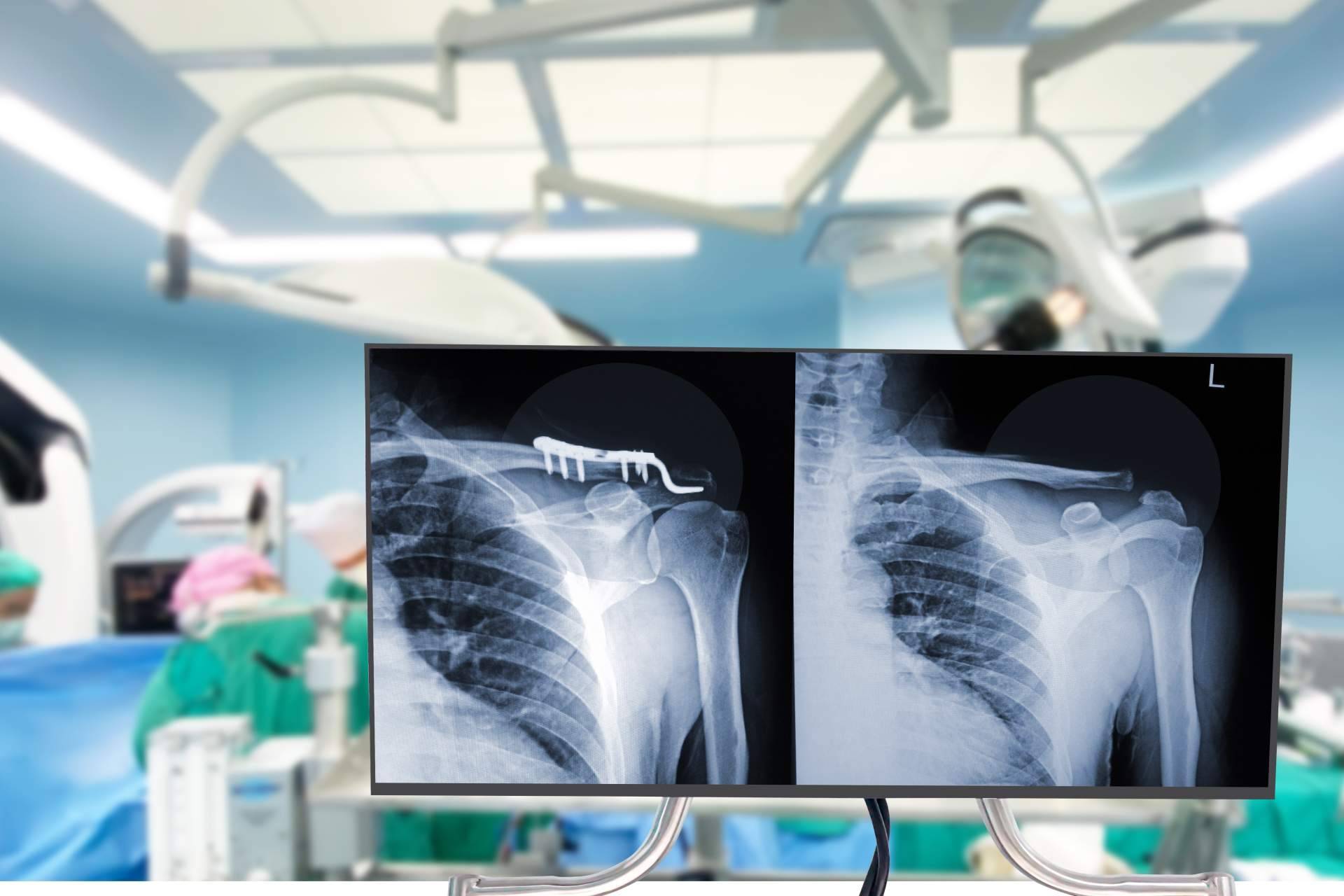 Los deportes en los que se produce un mayor número de fracturas de clavícula, por el Dr. Miguel Romero