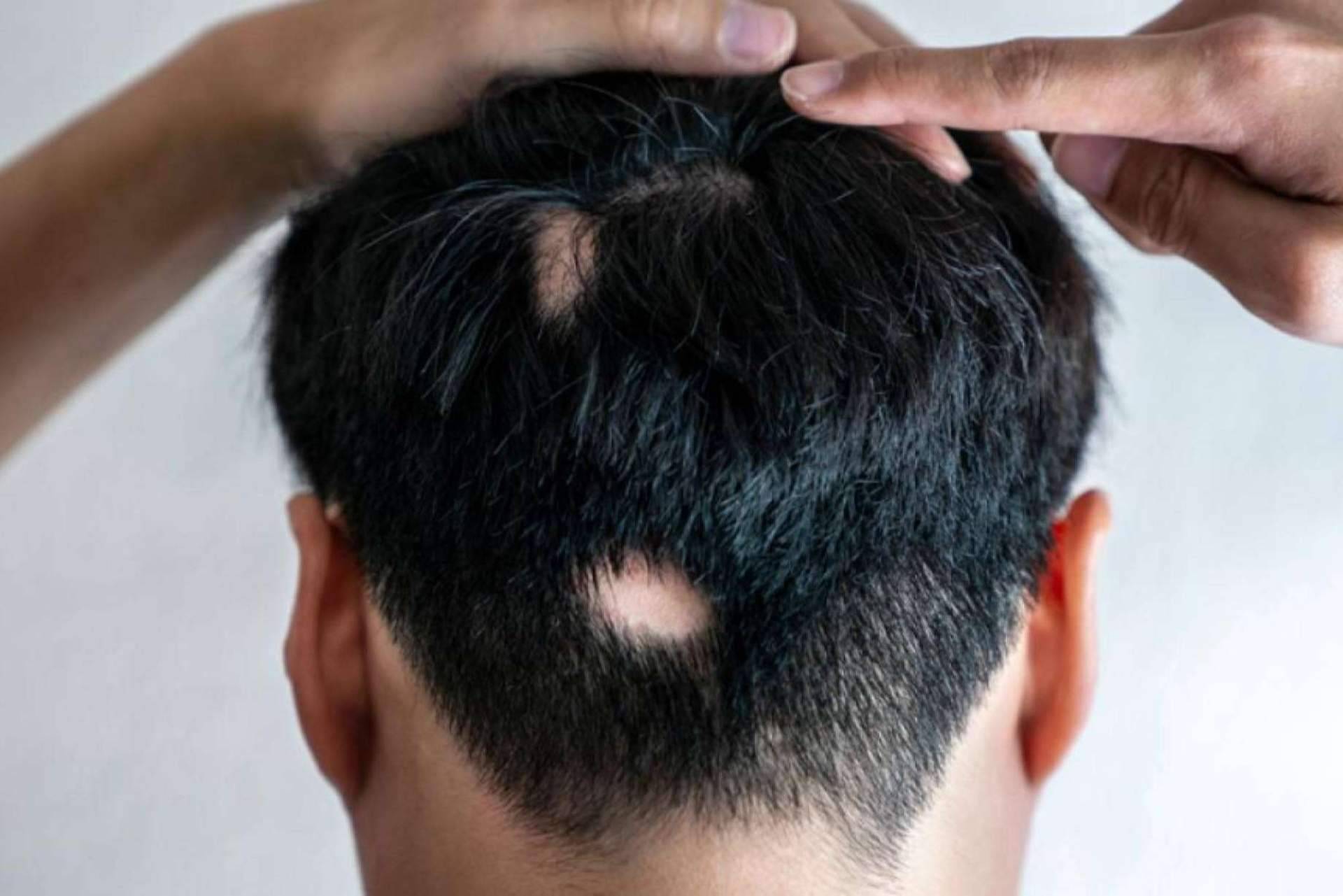 Alopecia Areata, ¿qué es y cómo disimularla?