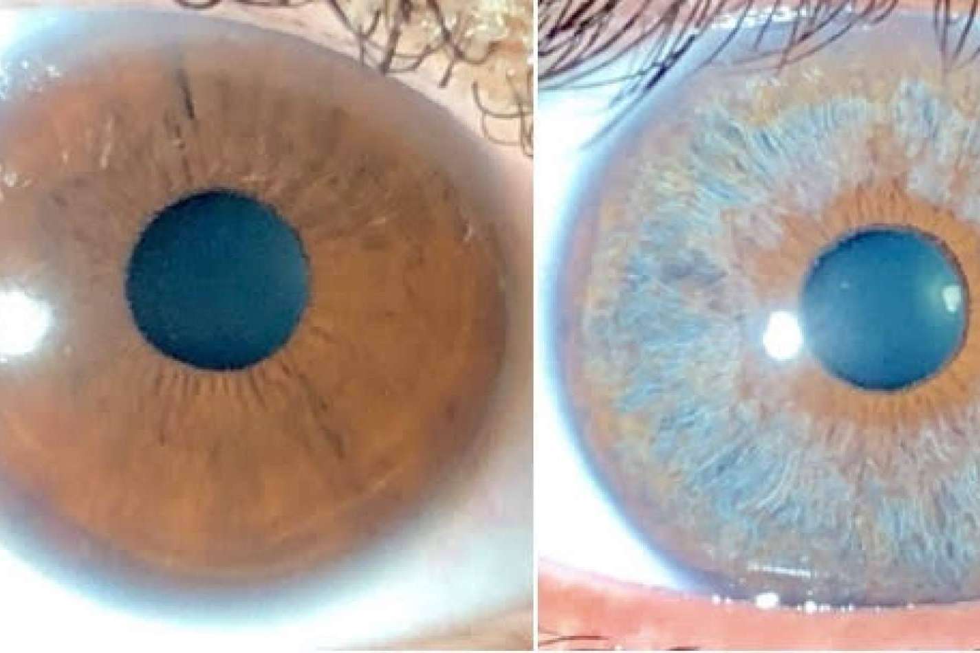 Los avances en las operaciones de cambio de color de ojos con láser, de la mano de Clínica Eyecos