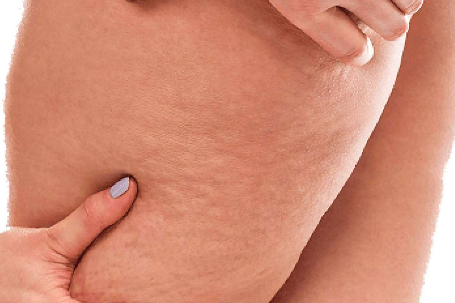 Los sensores especiales de Soluciones ayudan a identificar el nivel de la celulitis, con el objetivo de determinar los procesos y terapias acertadas