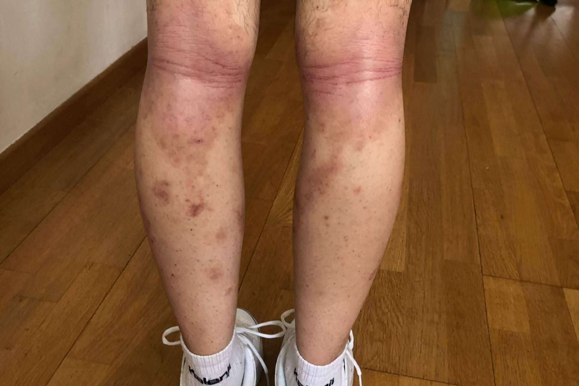Nüwa trata los problemas de la piel mediante la acupuntura y la fototerapia