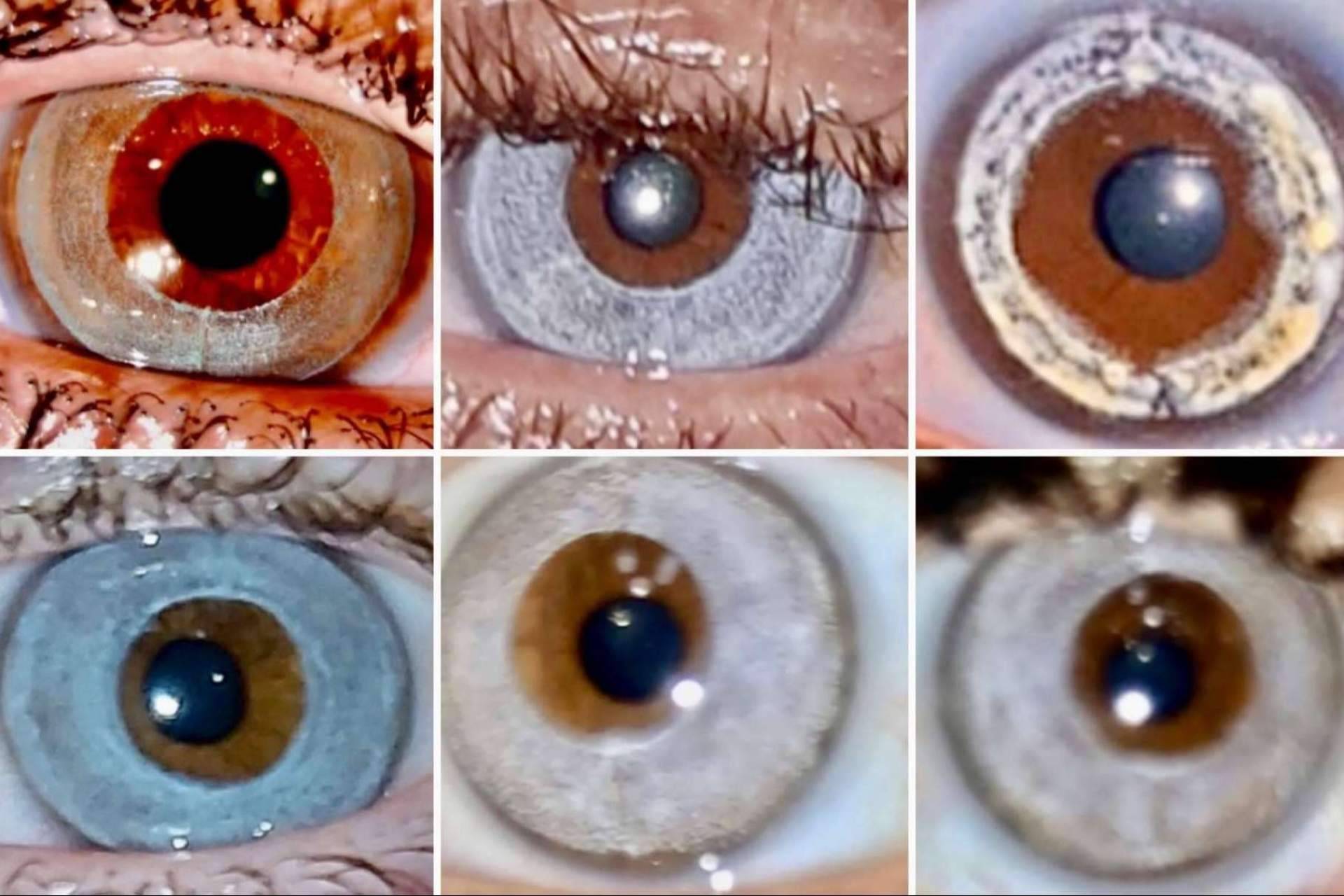 El láser NewEyes ofrece ventajas por encima de la queratopigmentación, por Clínica Eyecos