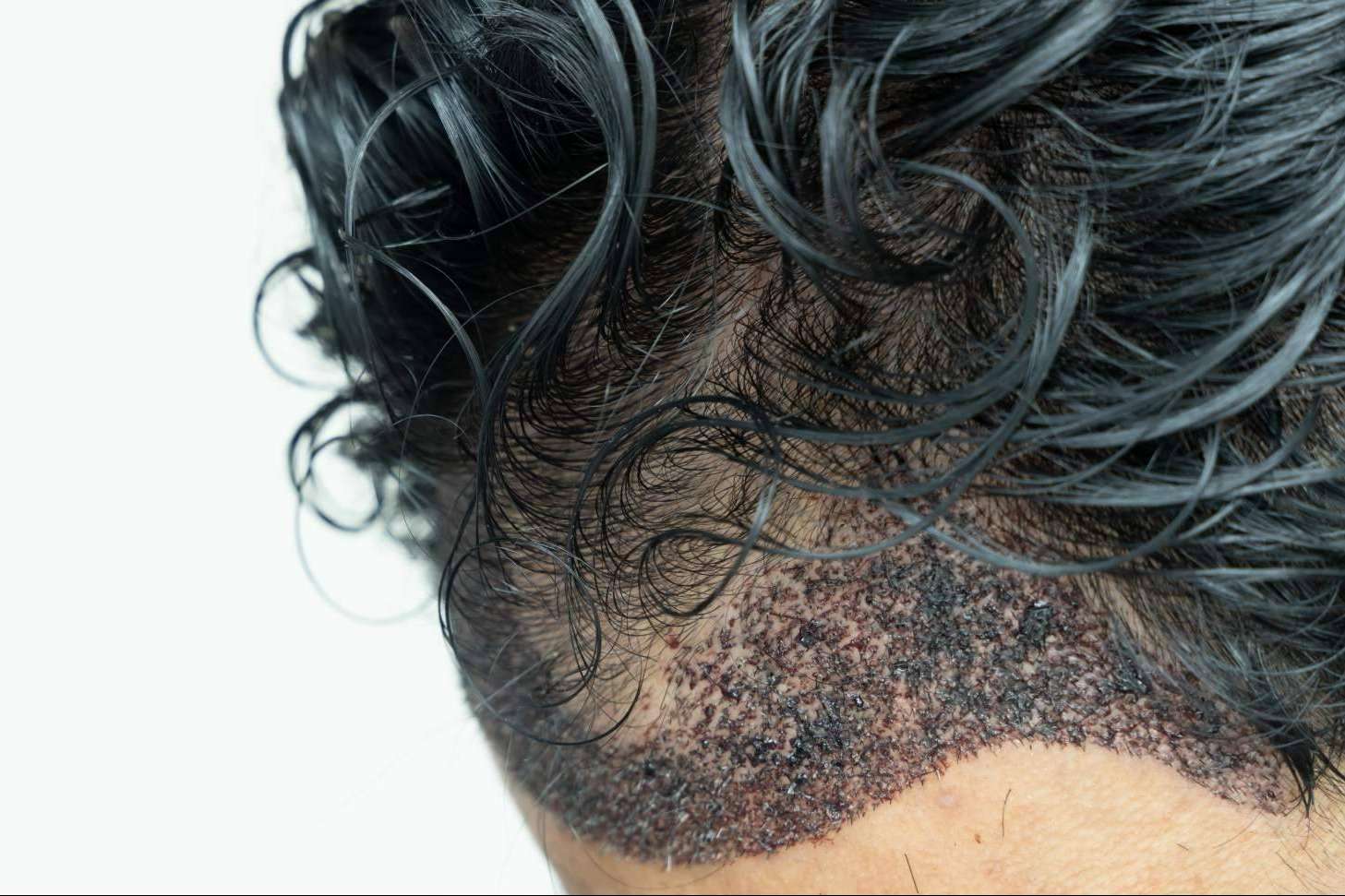 Microinjerto capilar para hombres en verano, de la mano de Capilar Innovation Clinic