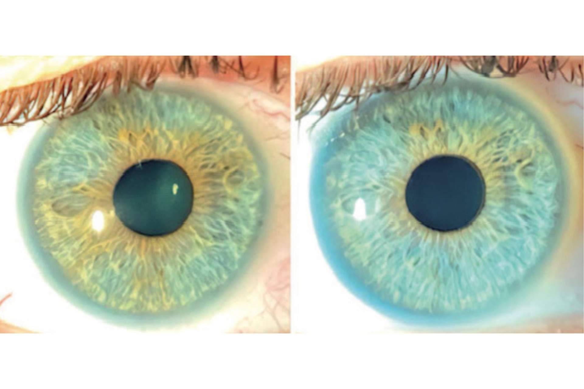 Clínica Eyecos afirma que los heterocromías y los nevus del iris pueden ser tratados con láser