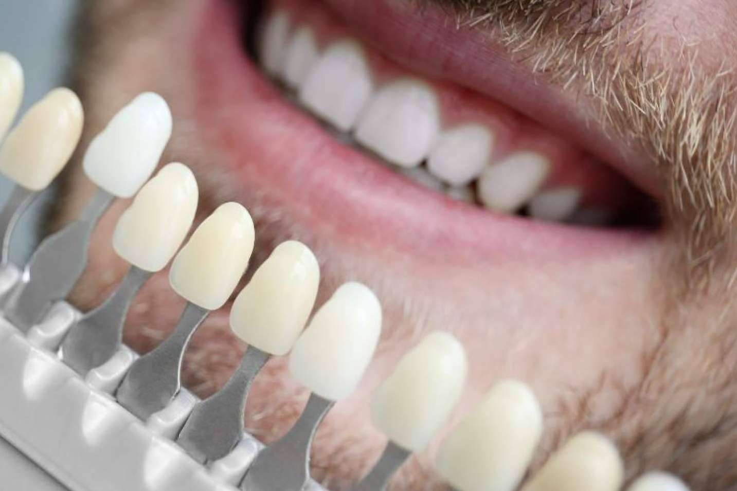 Los beneficios de las carillas de composite, por Clínica Dental Ruiz de Gopegui