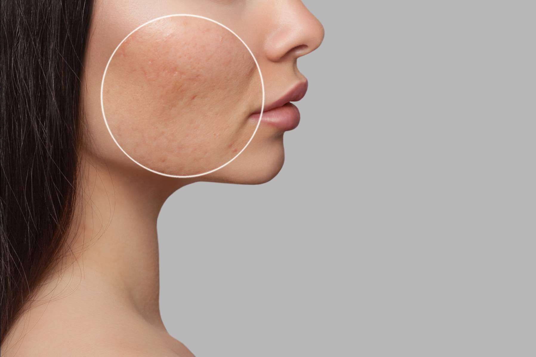 Alluring Clinic, tratamiento de cicatrices de acné con radiofrecuencia fraccionada con microagujas