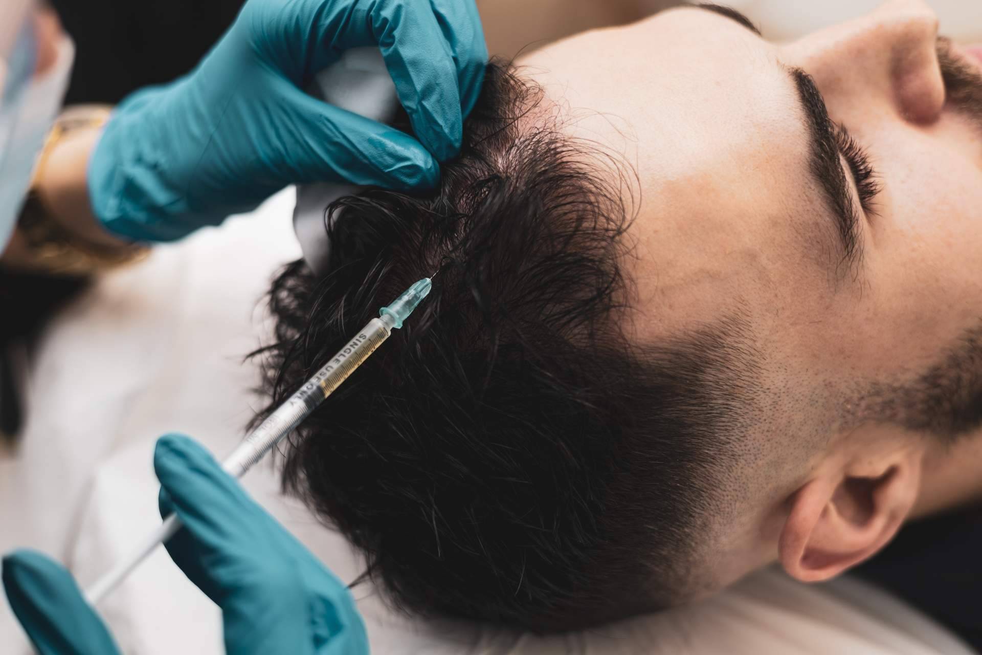 El tratamiento de mesoterapia capilar de Capilar Innovation Clinic, junto a su experto doctor Jesús Mora, para poner fin a la caída del cabello
