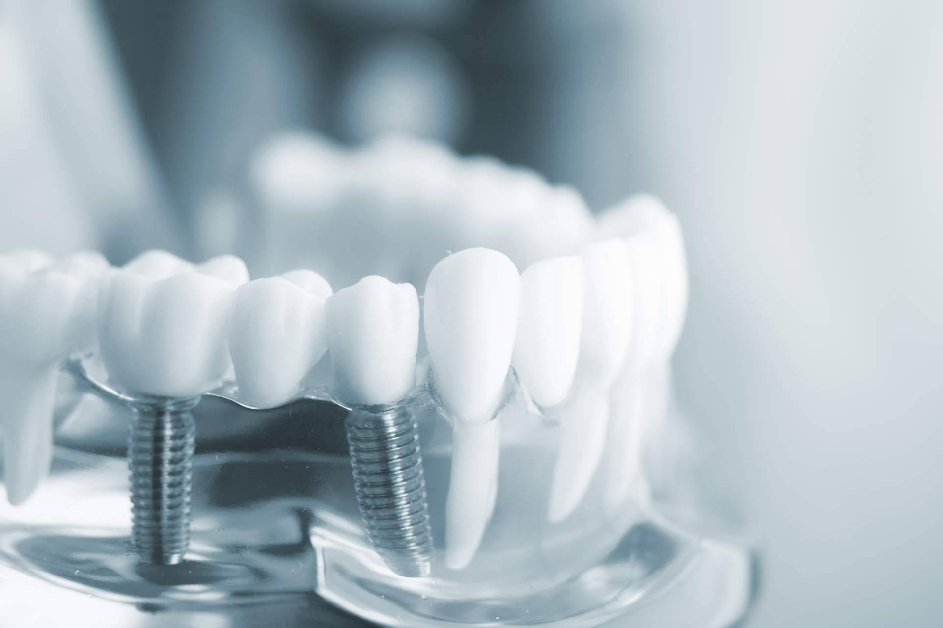 Las ventajas de los implantes de Zirconio, con DeltaDent