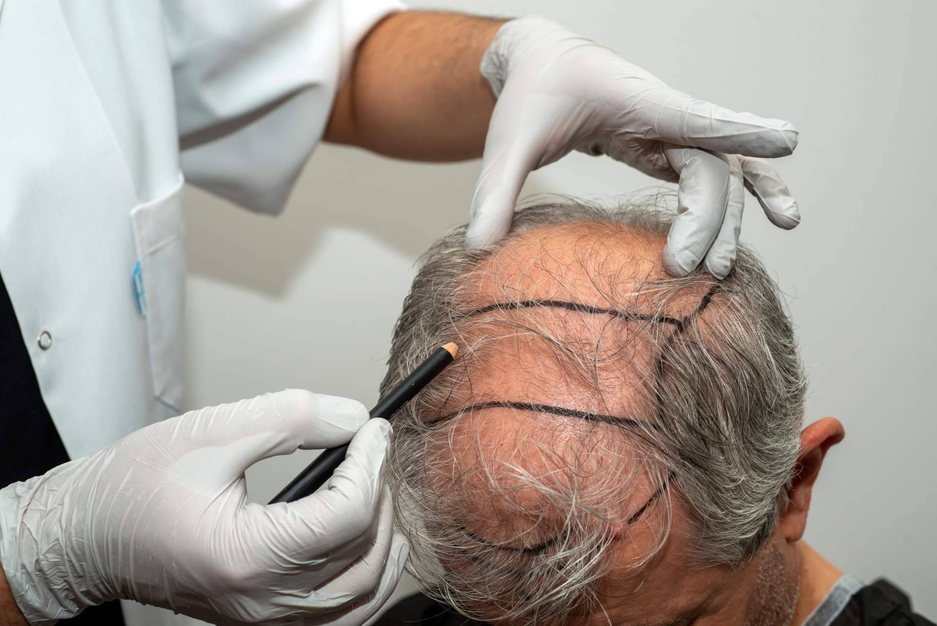 Microinjerto capilar FUE, solución definitiva y mínimamente invasiva para los casos de alopecia androgénica