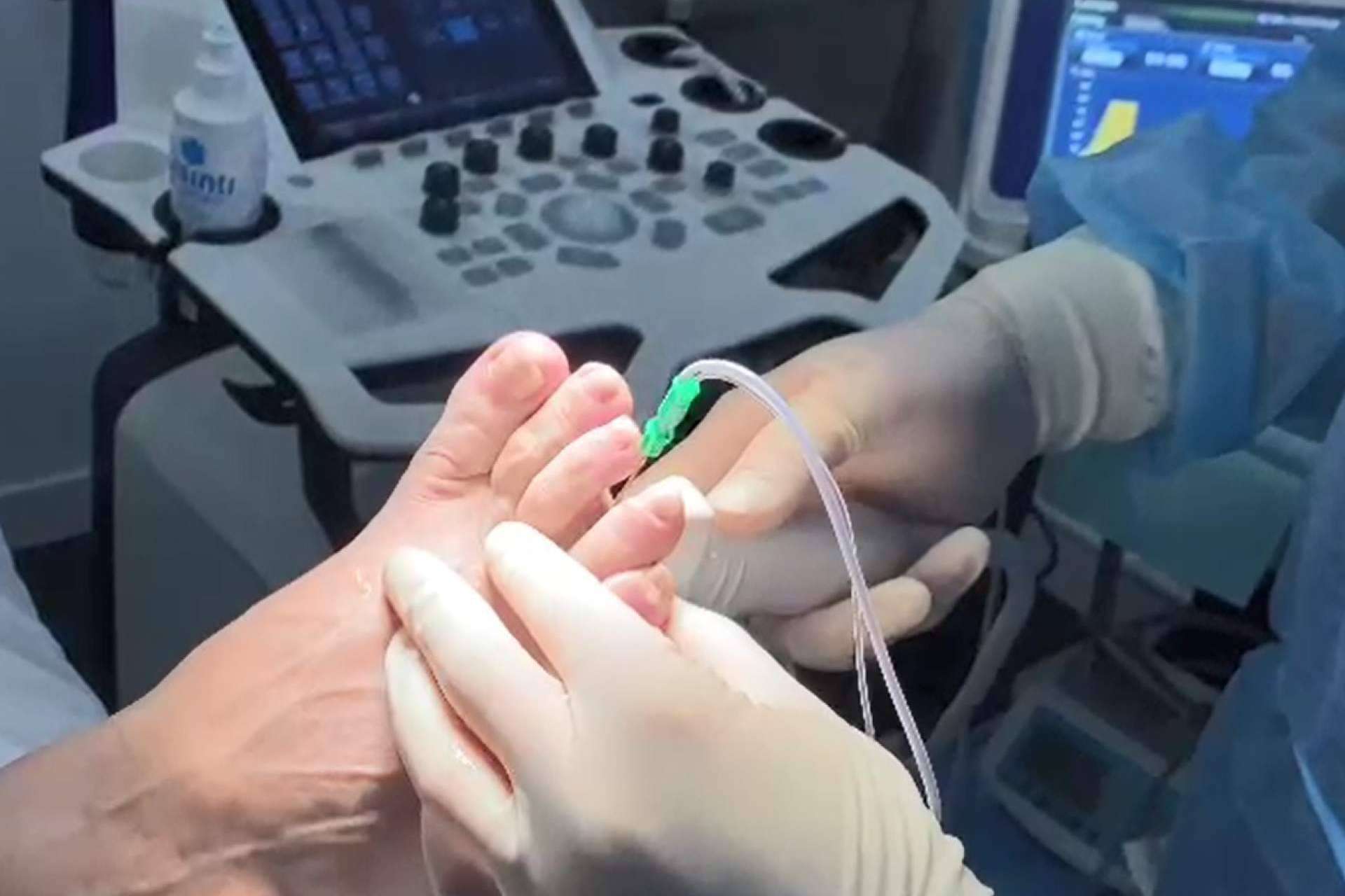 Alternativa no quirúrgica y sin incisiones para el neuroma de Morton