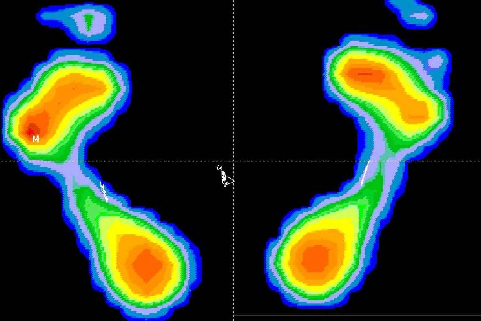 La importancia de un estudio biomecánico en el deporte, por Clínica Podológica M.O.