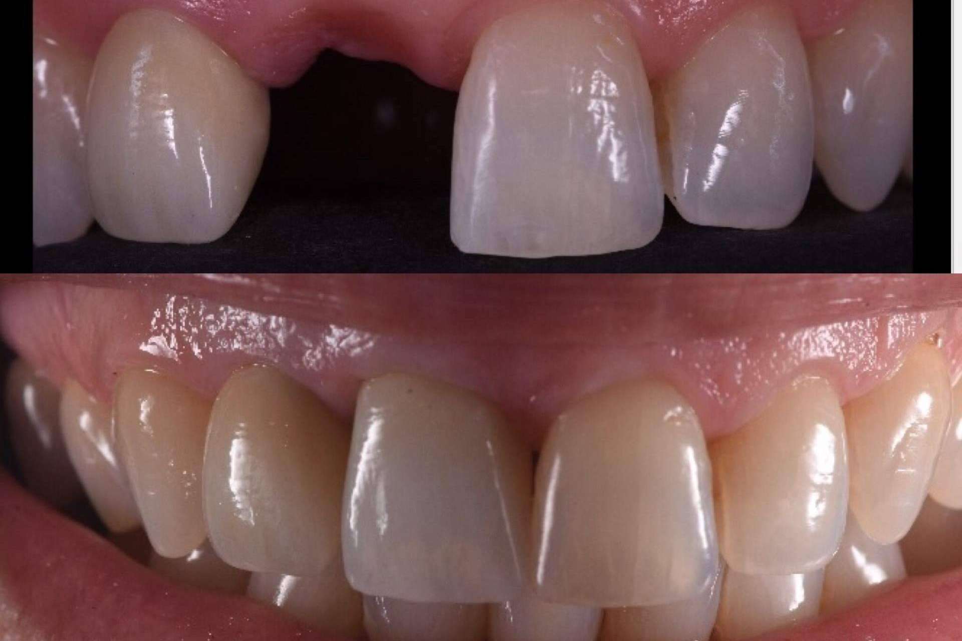 Clínica Calvo de Mora acerca de los implantes dentales que lleva a cabo
