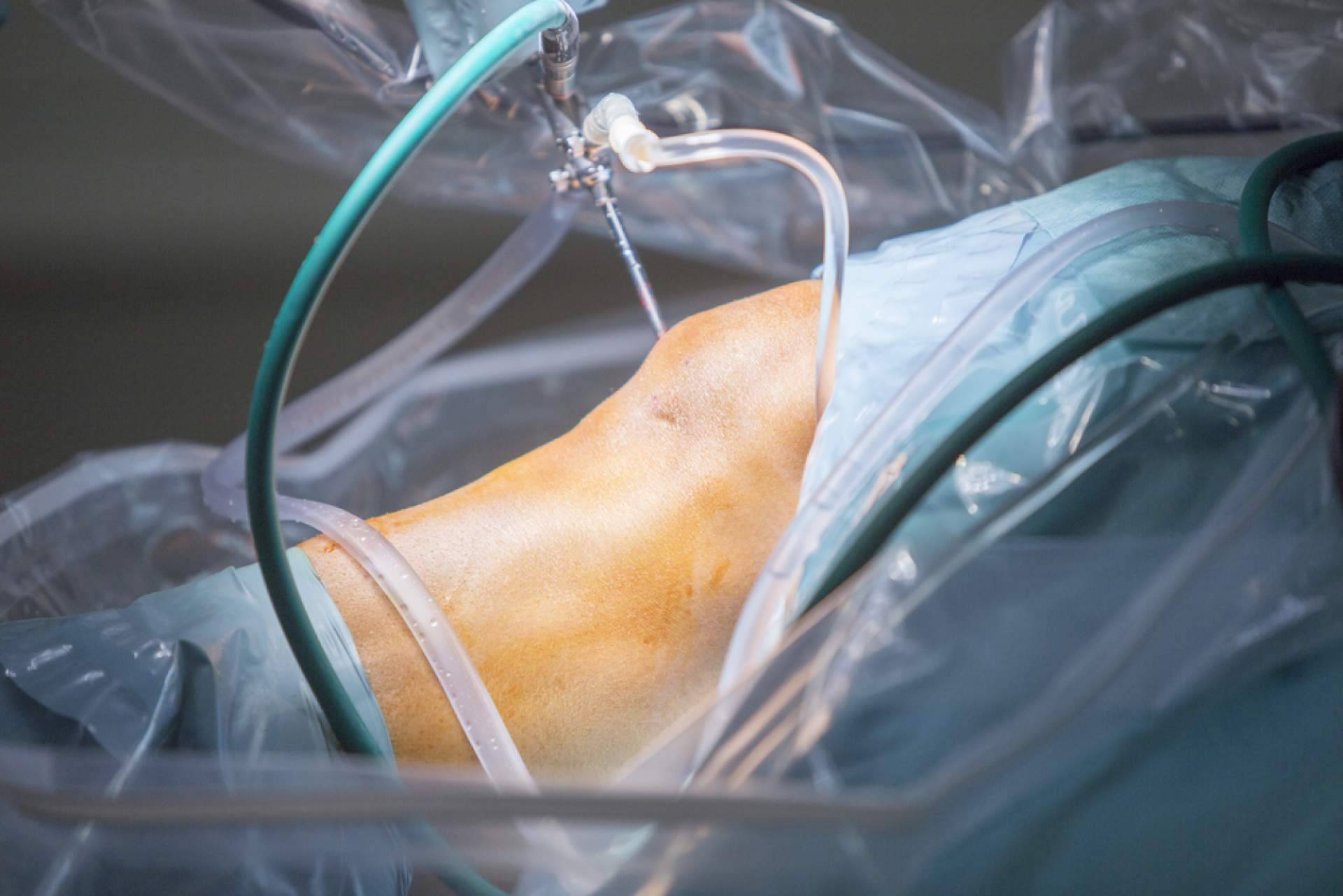 Tratamientos de artroscopia de rodilla en la Clínica Jaime I de Catarroja