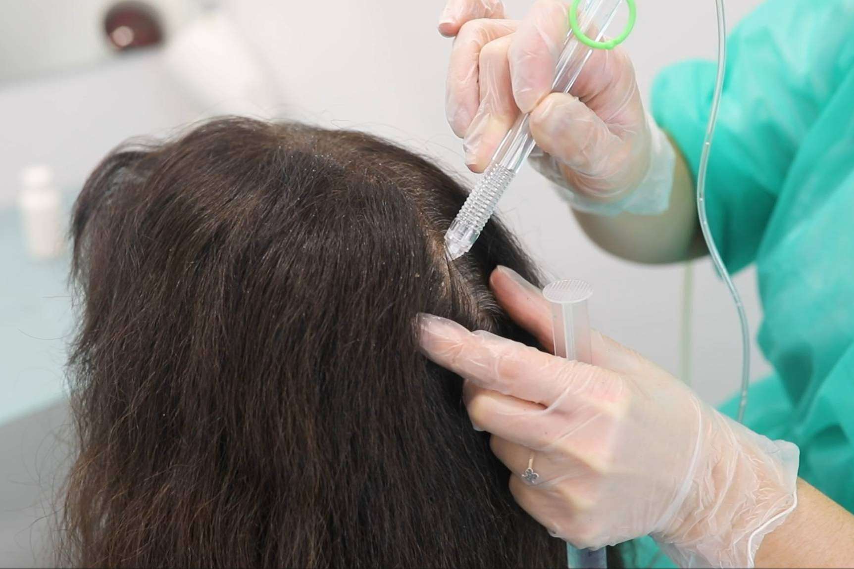 VitaX Regeneración con Minoxidil de IMD Instituto Médico Dermatológico frena la caída capilar