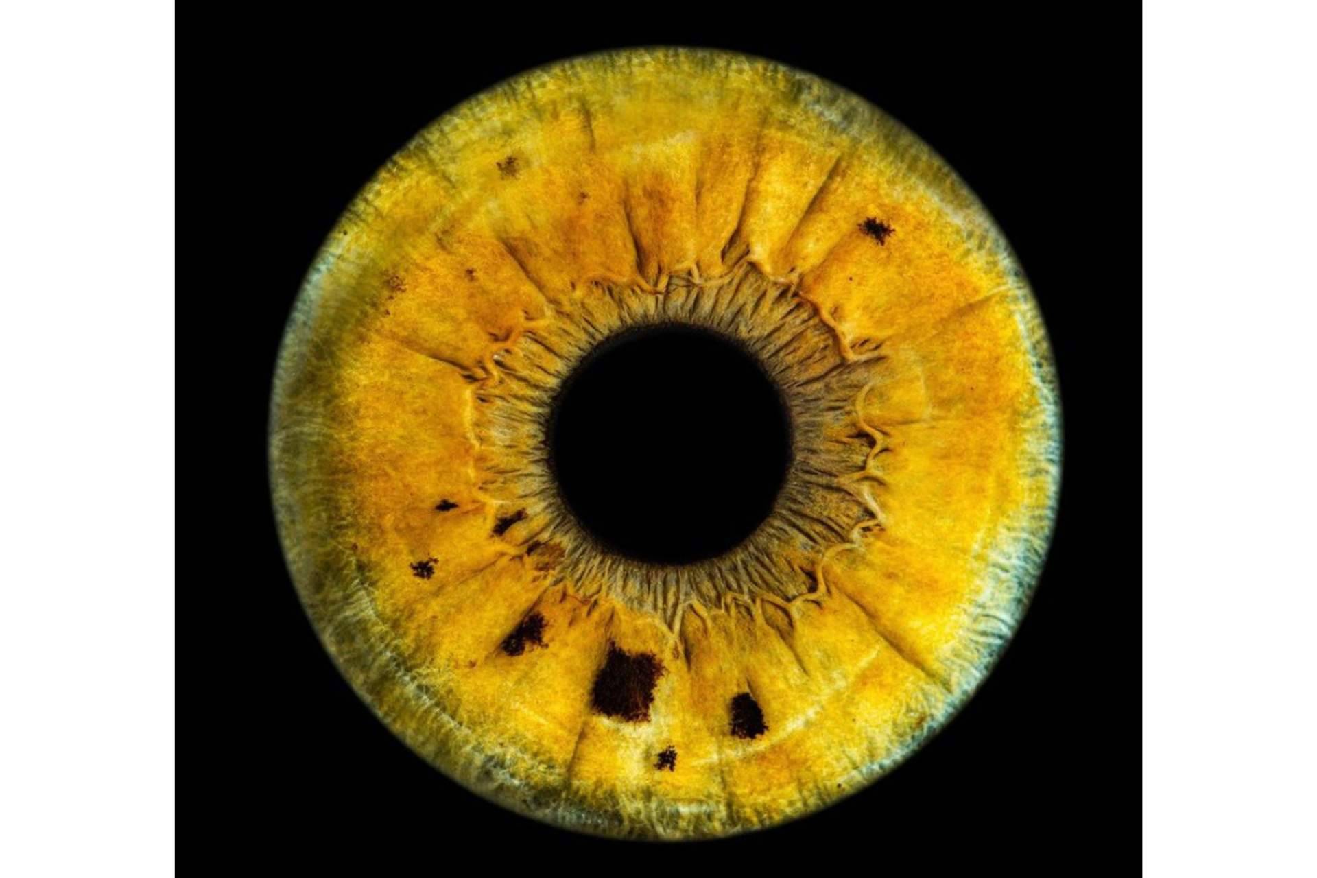 Clínica Eyecos presenta algunas celebridades con heterocromía ocular