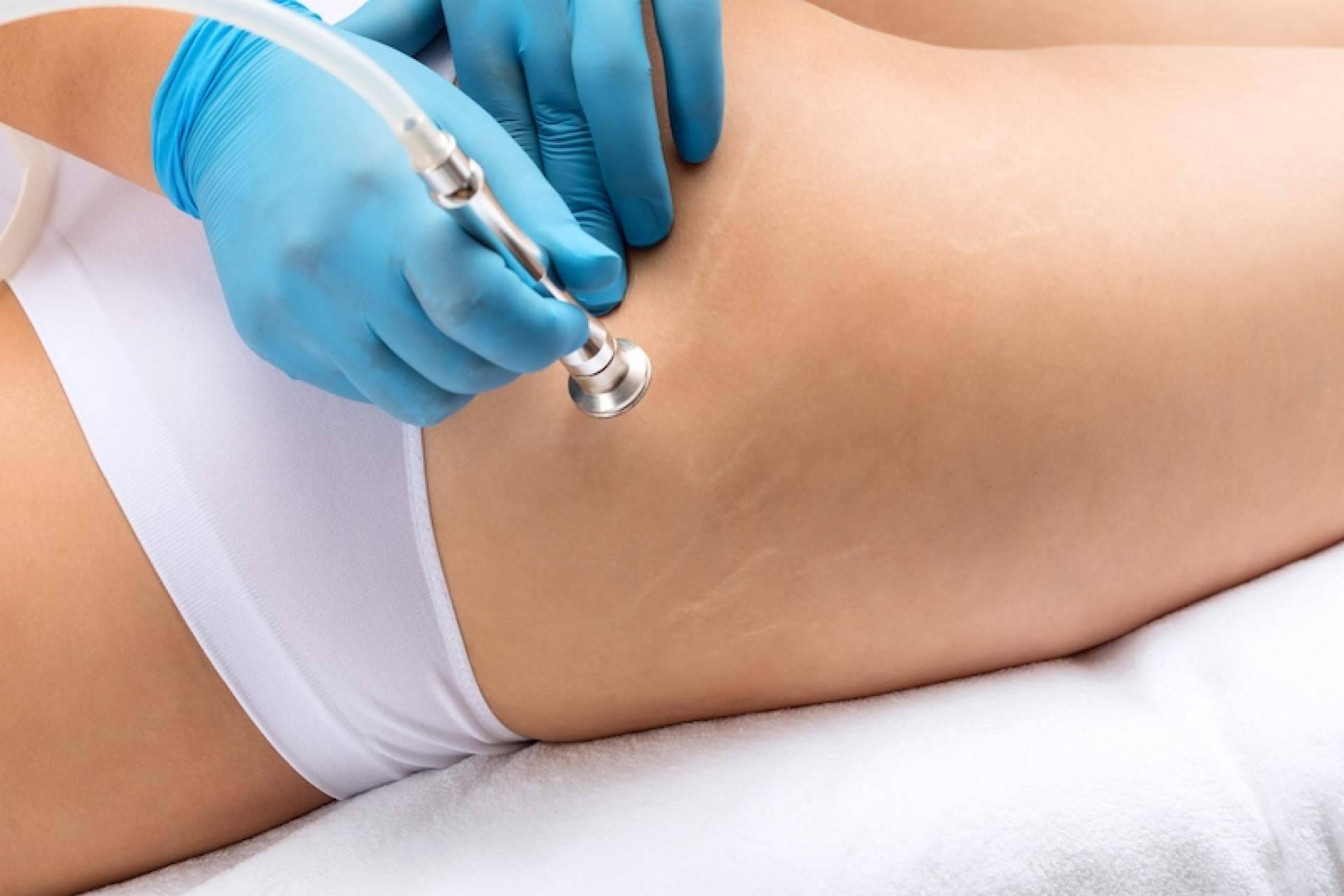 Las ventajas de eliminar estrías, con la Clínica Estética Pilar