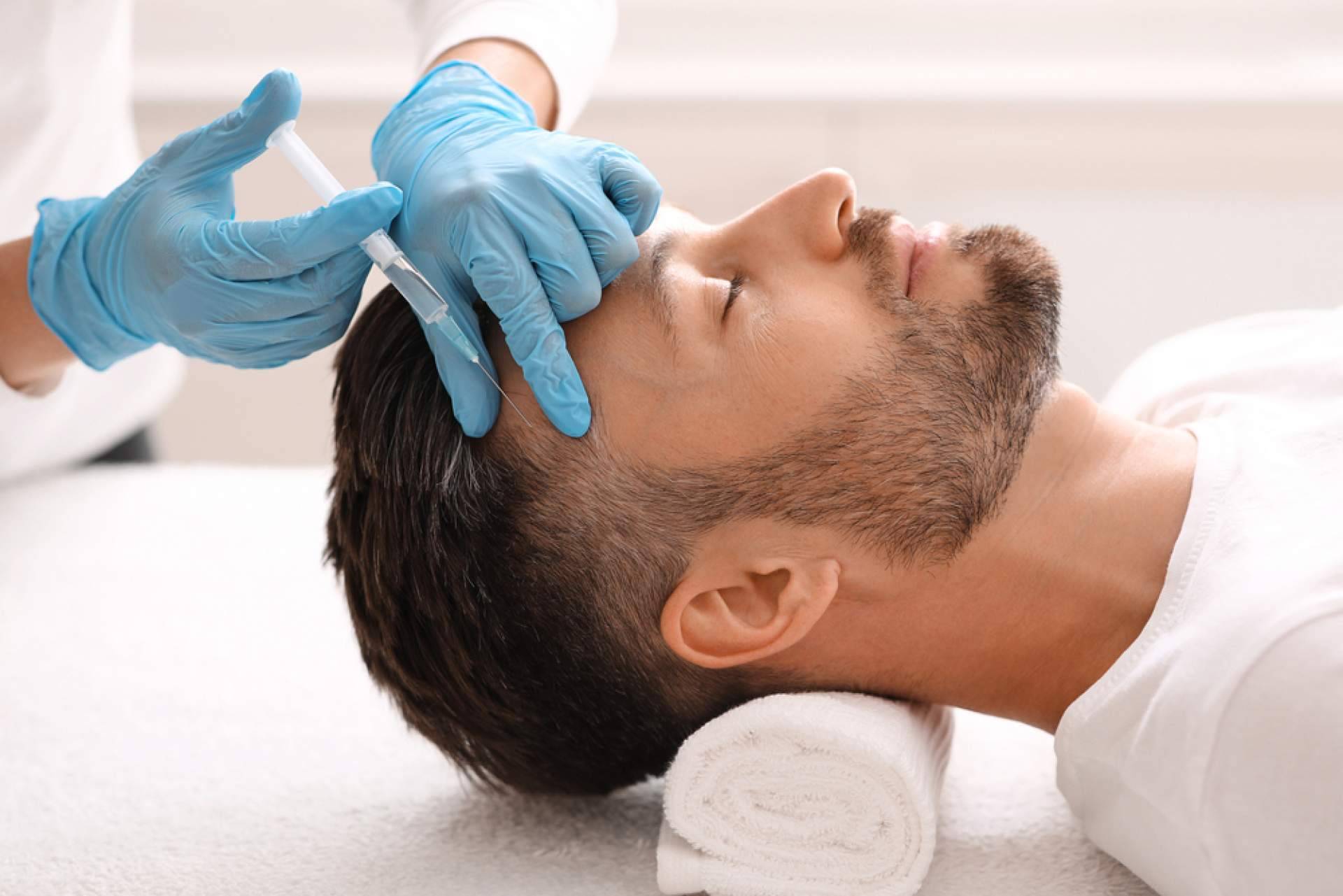 Mesoterapia capilar, la terapia sin cirugía que combate la caída del cabello