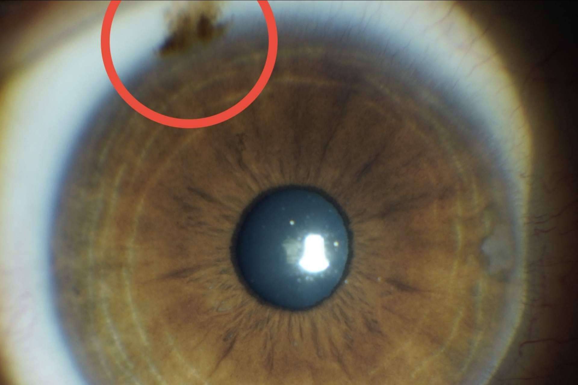 Tratamiento láser de las manchas pigmentarias de la conjuntiva