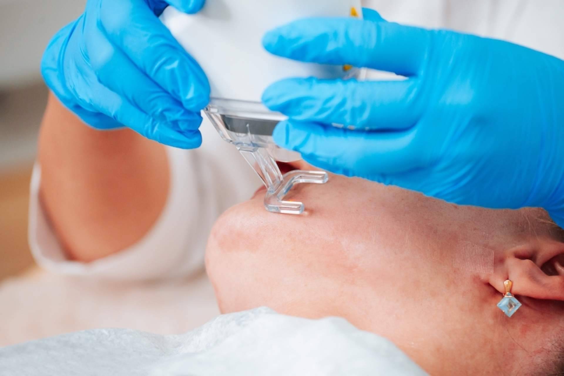 Las ventajas de recurrir a tratamientos para eliminar cicatrices, con Centro Estética el Pilar