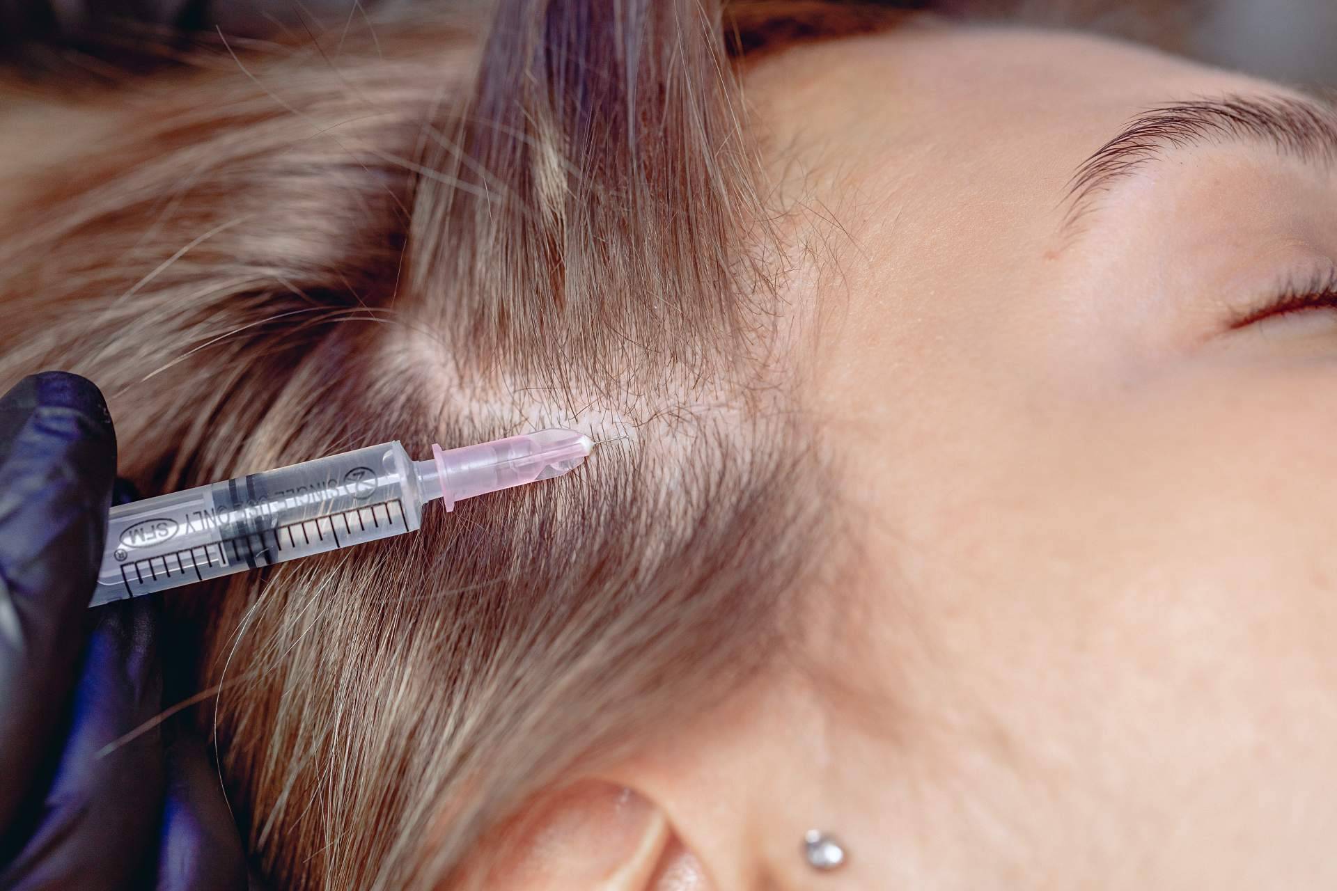 Tratamientos de mesoterapia para el cabello con Capilar Innovation Clinic, de la mano del doctor Jesus Anibal Mora