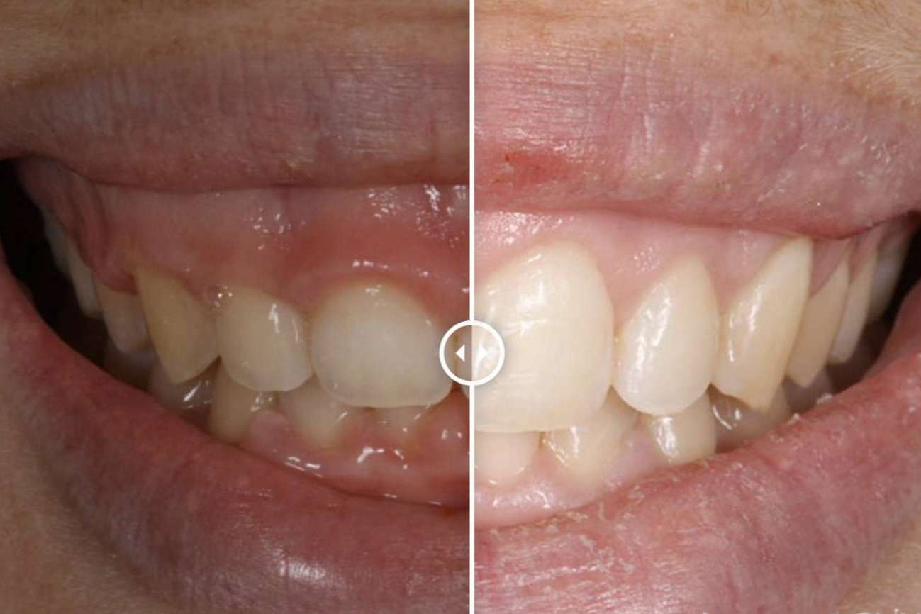 ¿Cómo se puede corregir la sonrisa gingival?, por Clínica Dental Ruiz de Gopegui
