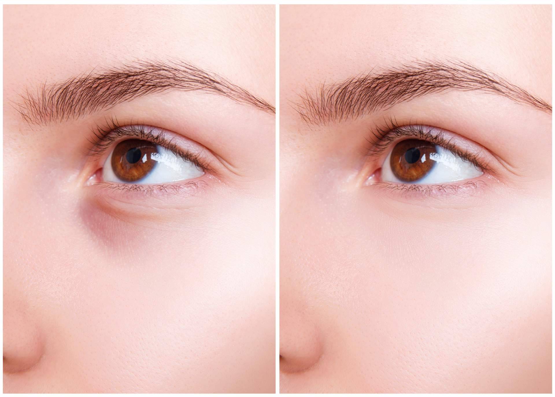 Eliminación de ojeras con ácido hialurónico en el Centro Médico El Pilar