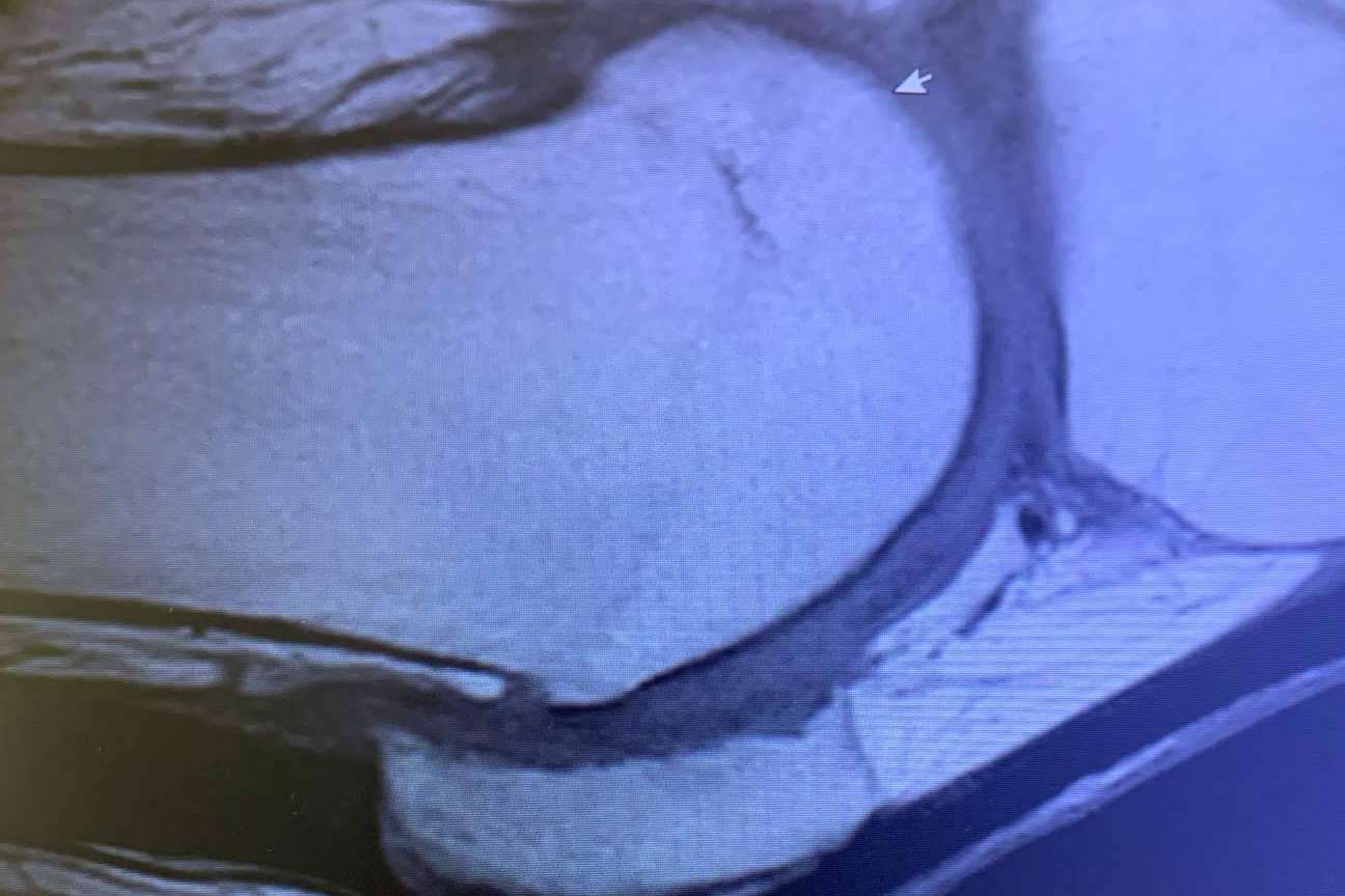 Los nuevos tratamientos para la artrosis y retrasar el envejecimiento del cuerpo