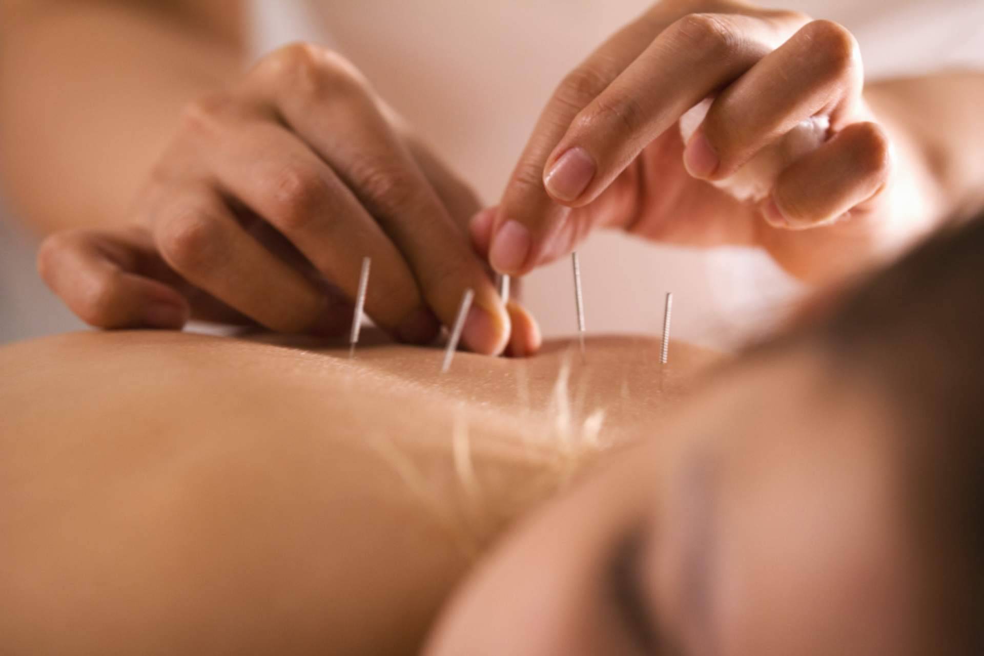 La acupuntura tiene múltiples beneficios para la fertilidad, según Shenti Wellness
