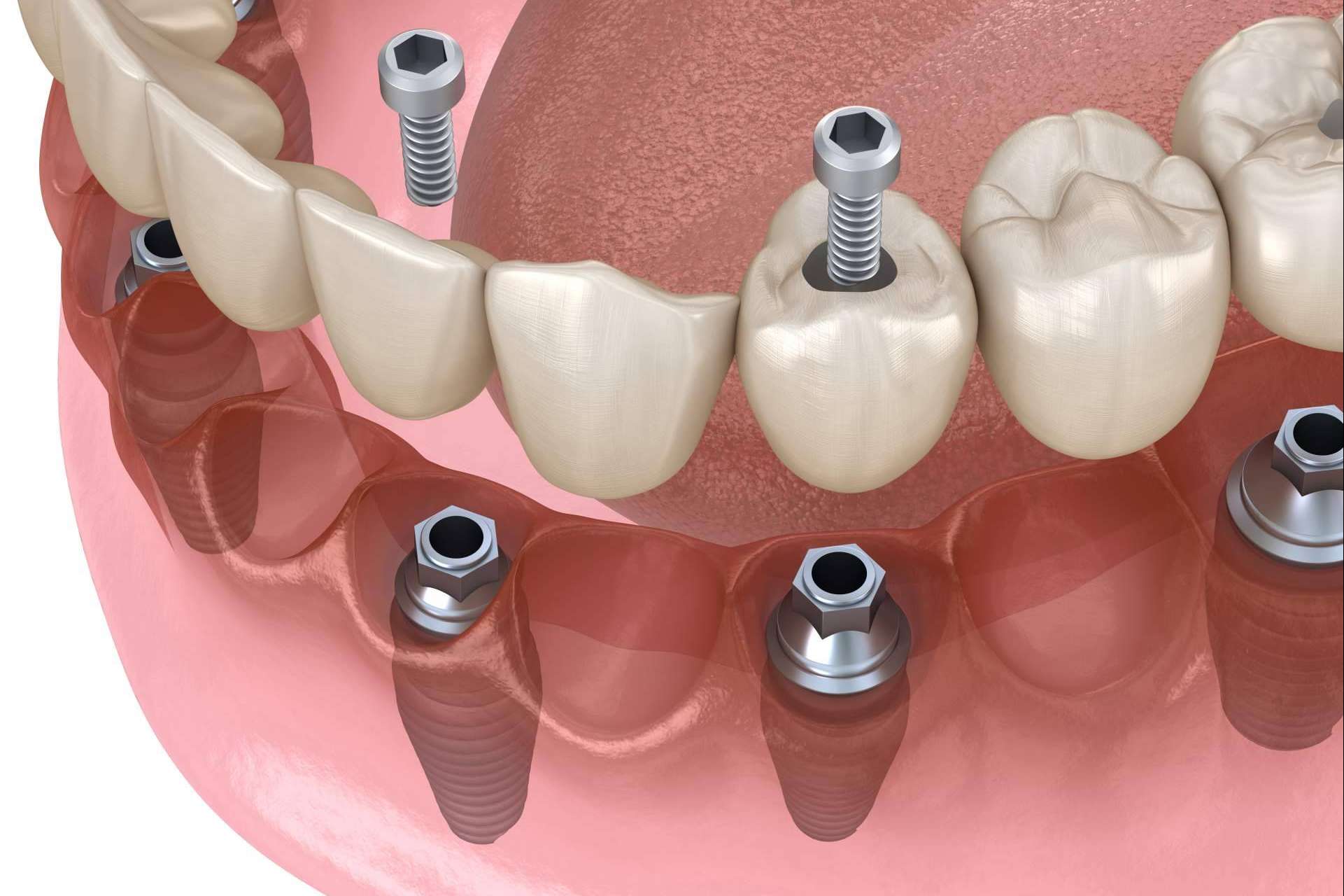 Recuperar la mejor versión de la sonrisa con los implantes dentales inmediatos de DeltaDent