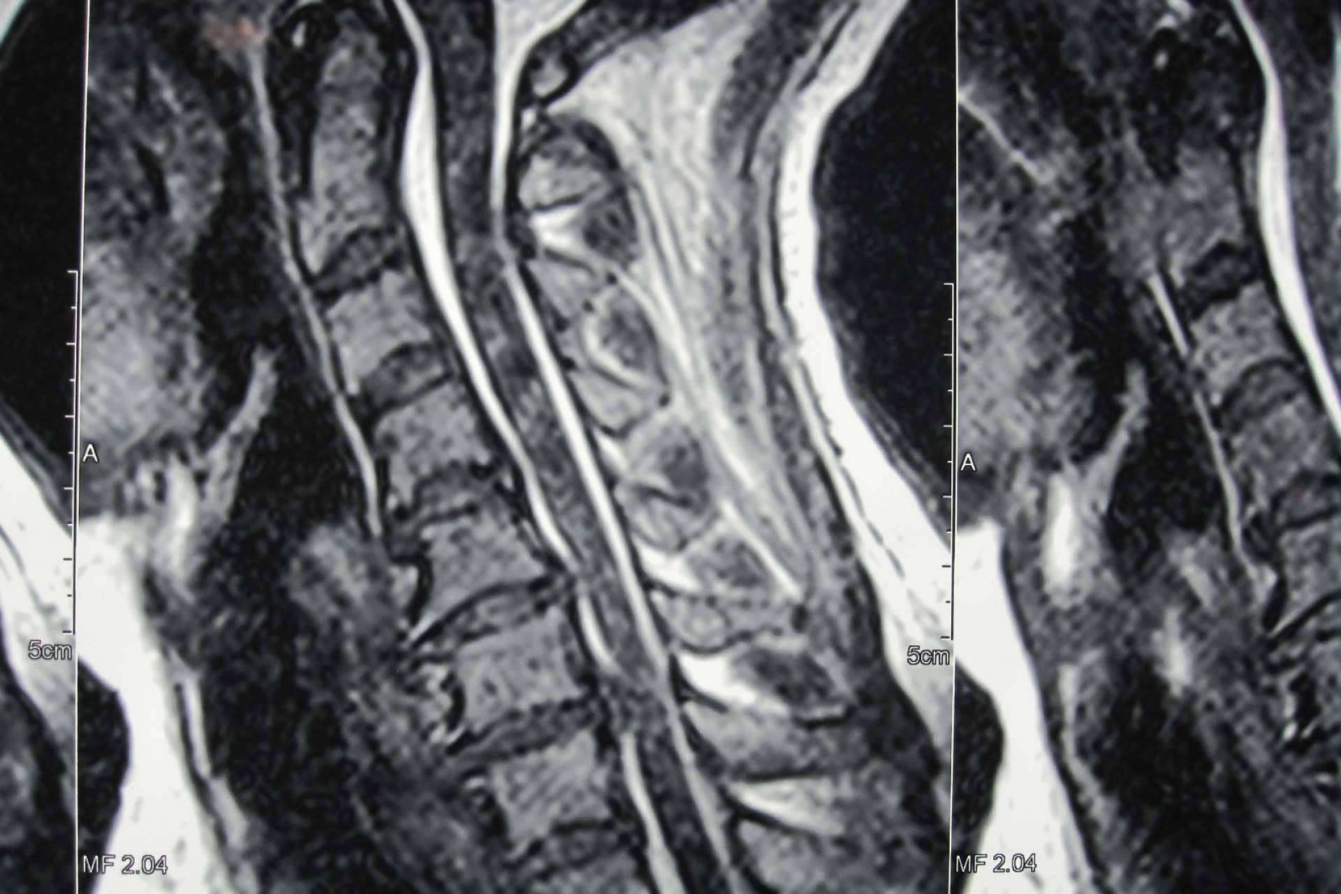 Neurocirugía Galarza informa sobre la hernia disco cervical
