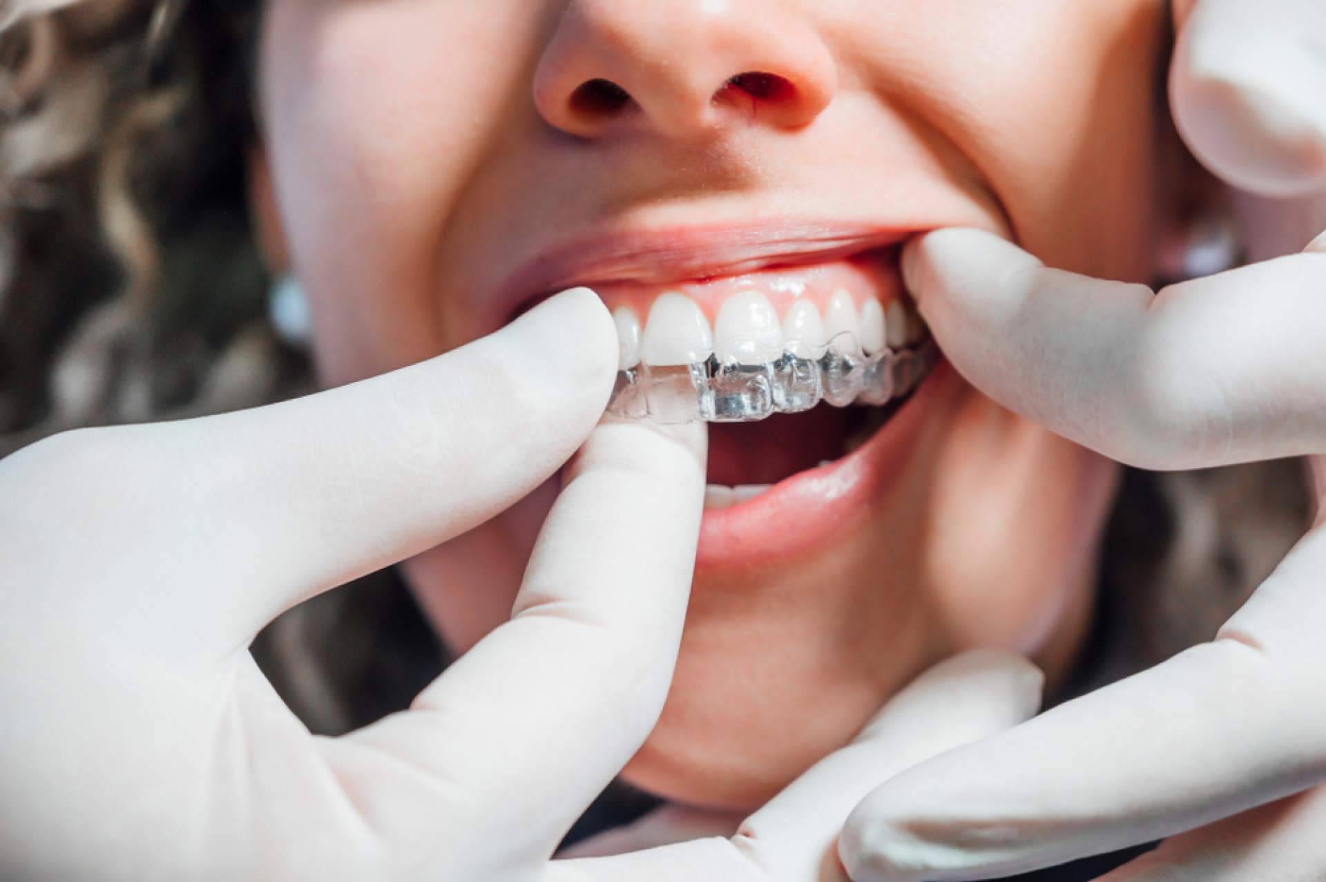 Los beneficios de la ortodoncia Invisalign, por InterORALIA